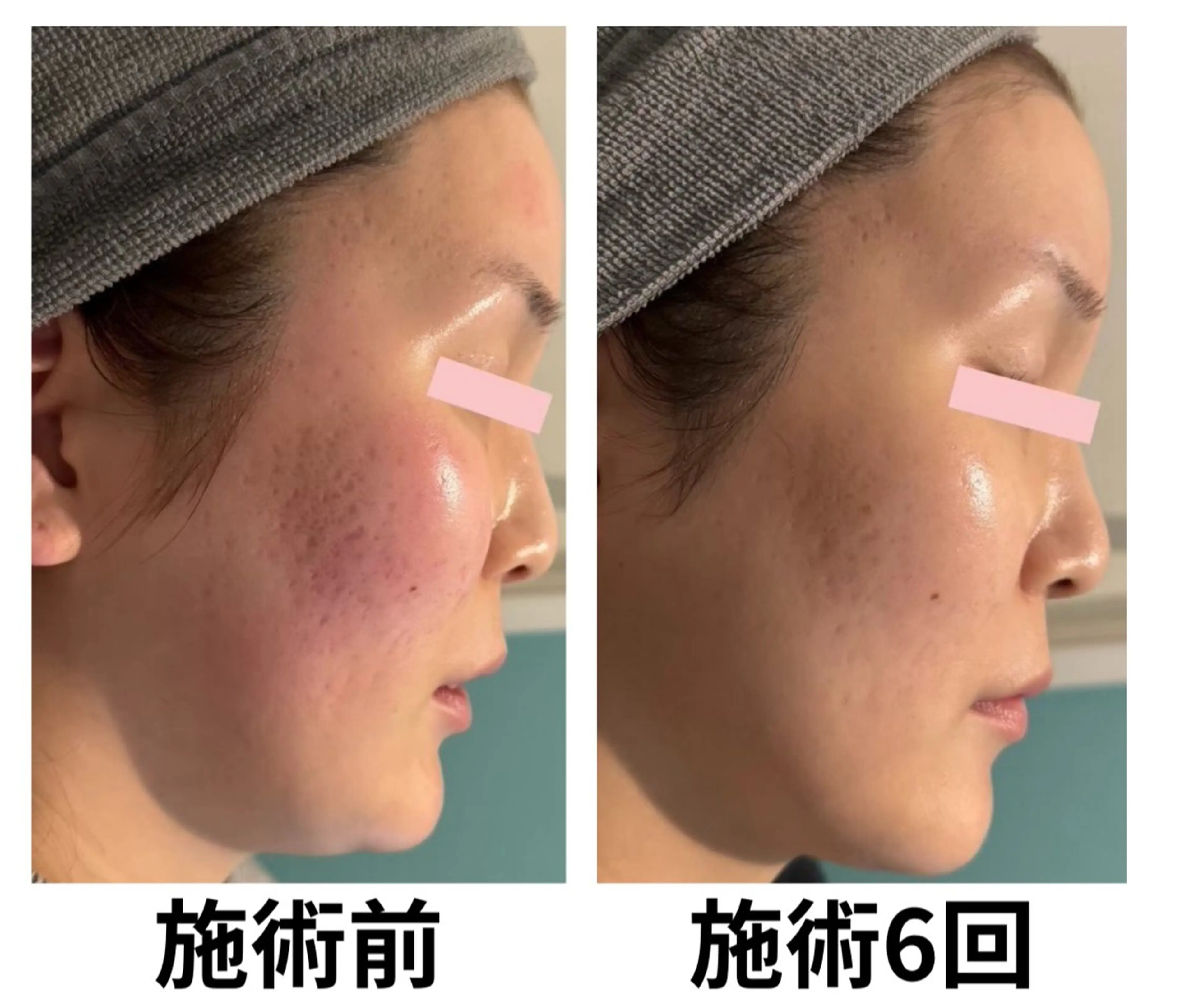 毛穴・ニキビ専門 エステグレースティーのエステ・リラクイメージ