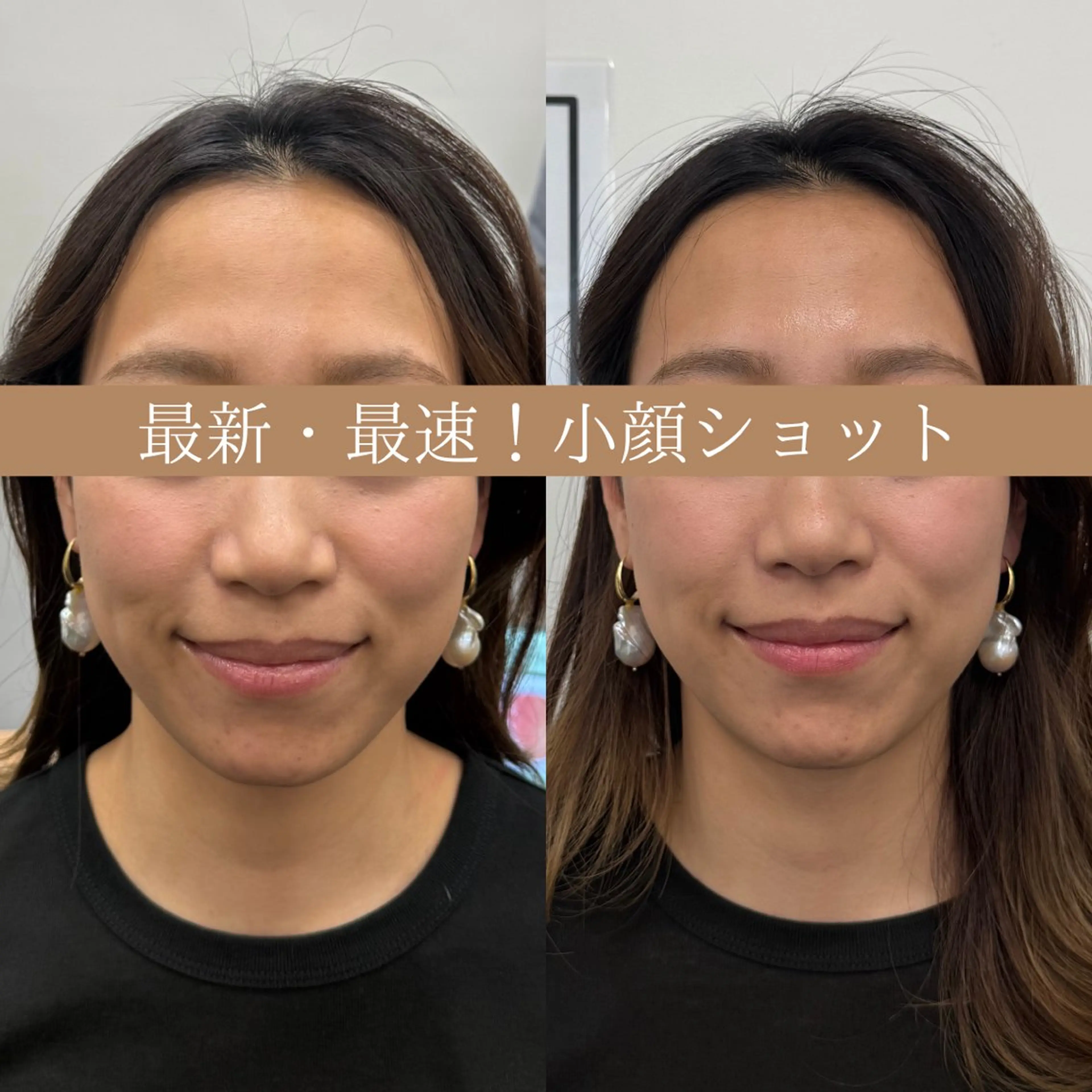 期間限定🈹名古屋初導入！超最新・小顔ショット💆‍♀️⚡️(本番韓国より仕入れ🇰🇷✨️最速・最短で小顔へ🪄❤️)の写真