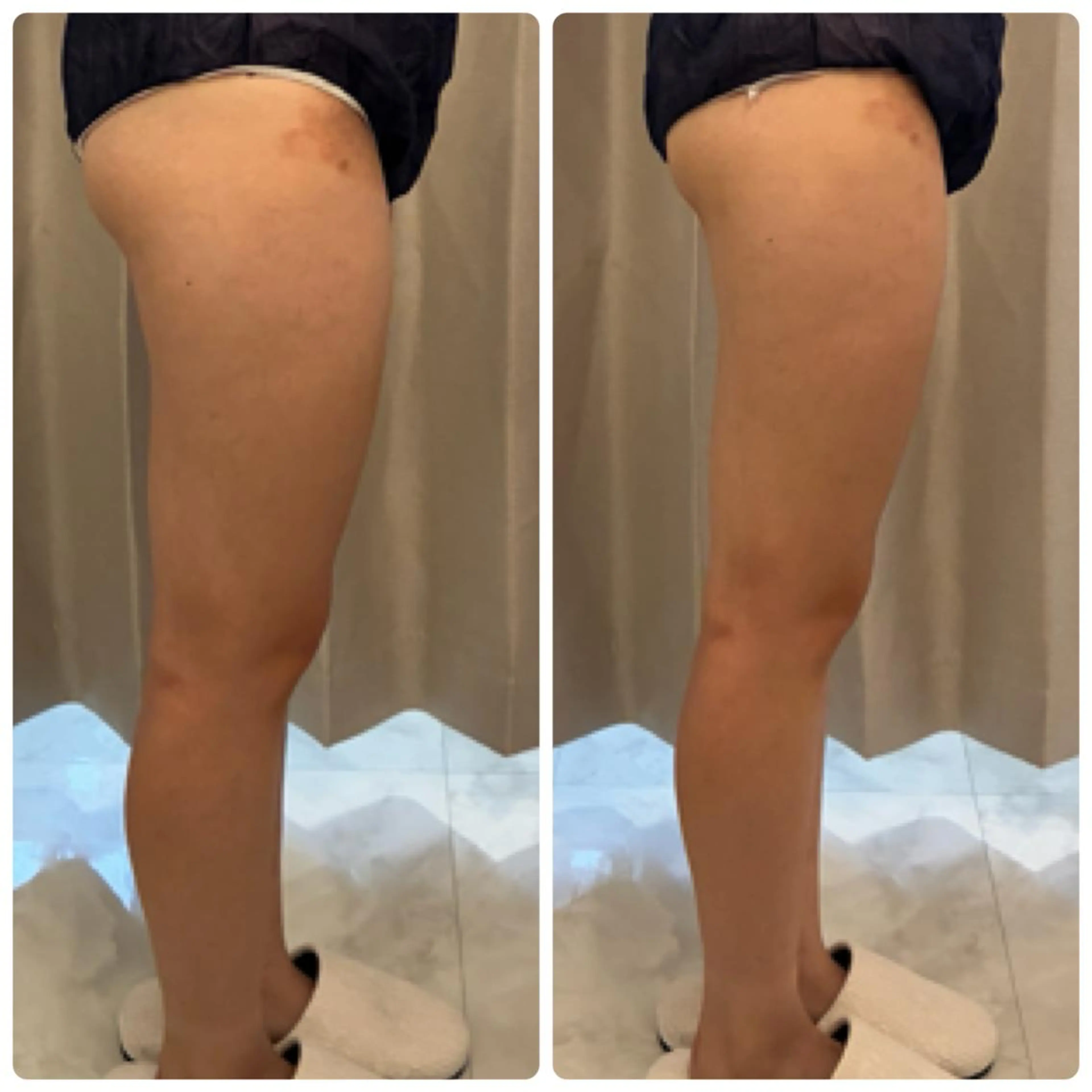 ボディ痩身お試しショット8000❤️🔥部分的に絞りたい方はこちらでお任せください✨の写真