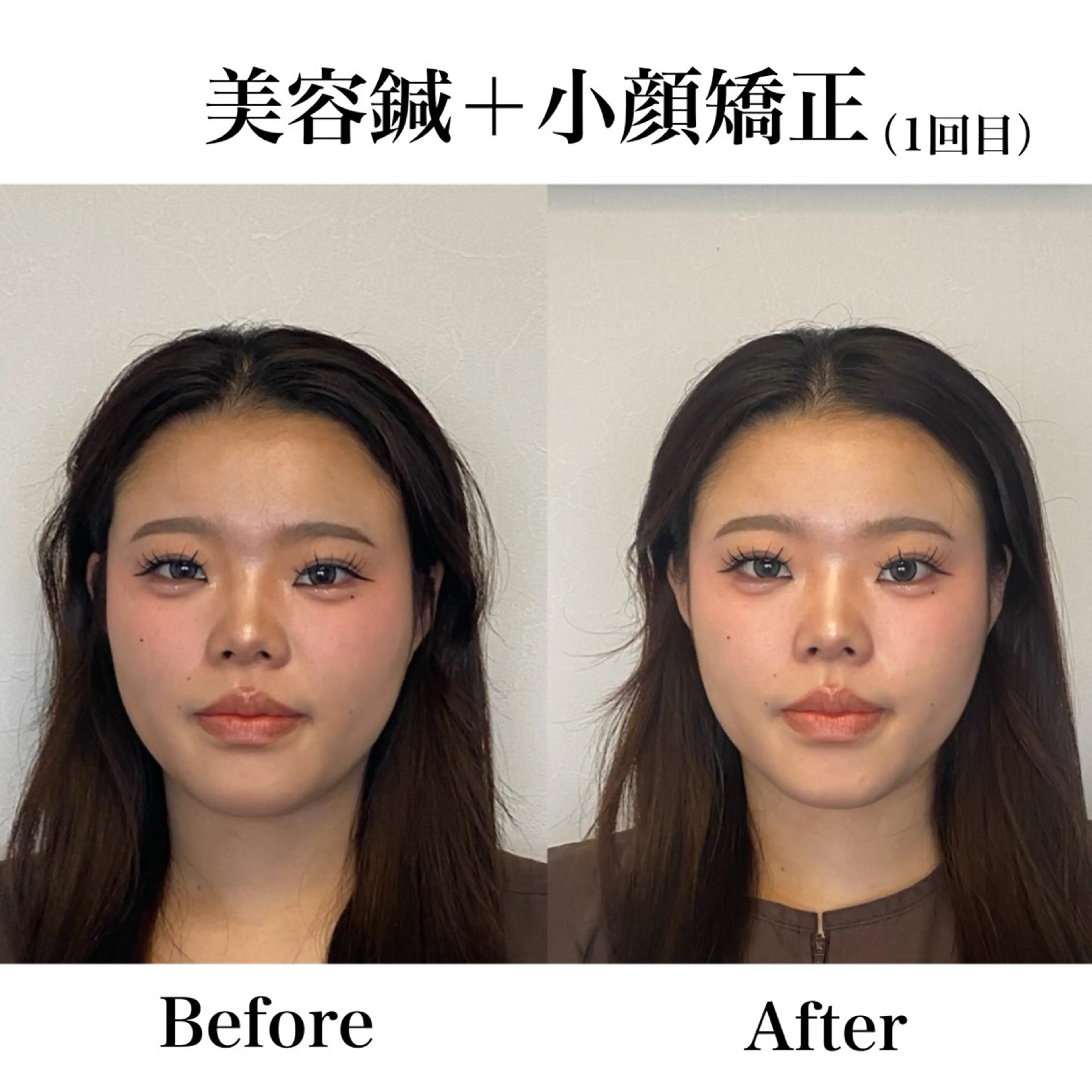 💎初回限定💎小顔矯正＋美容鍼付き✨の写真