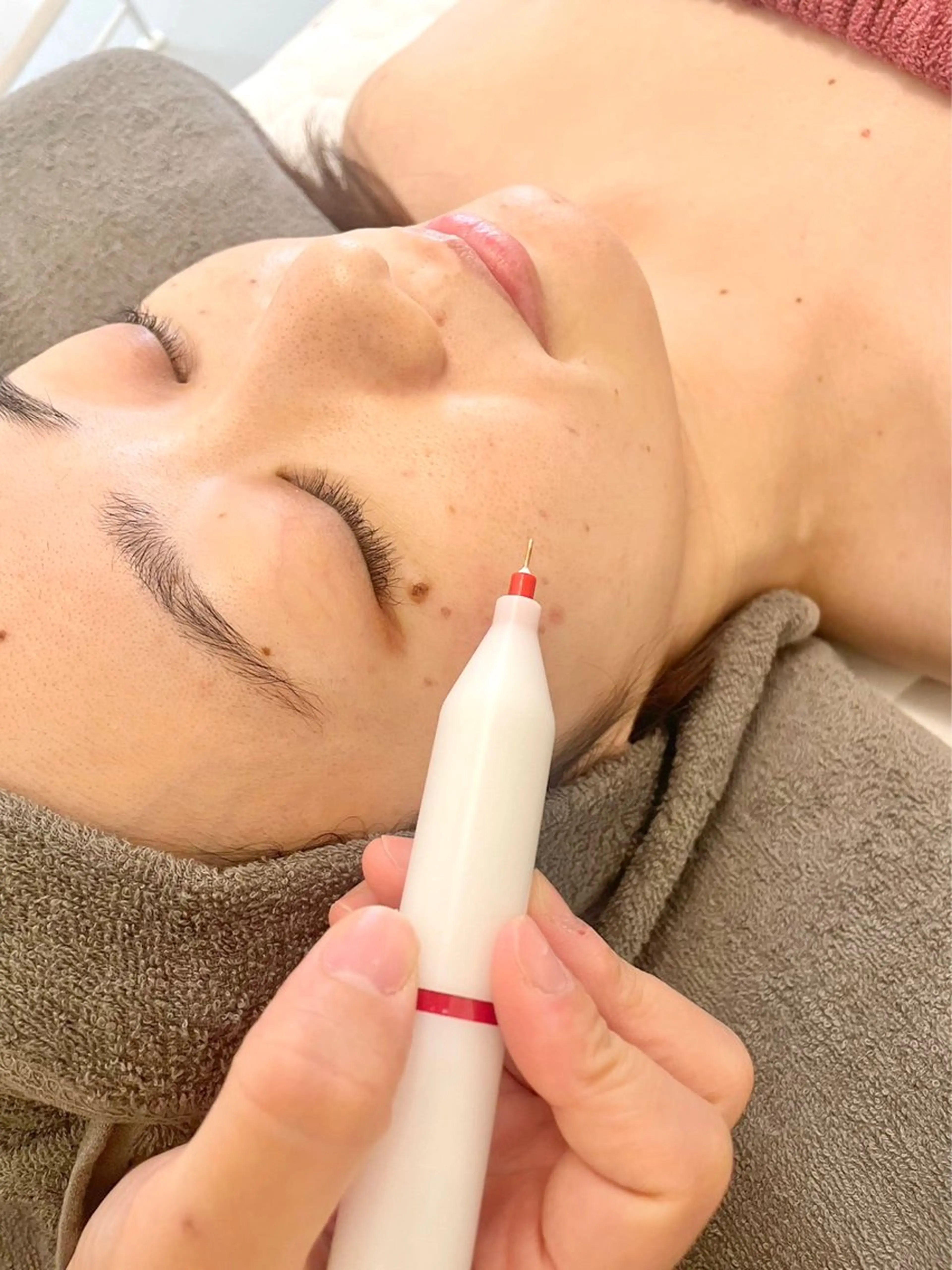 【産後のシミ撃退】シミを垢にして排出する🔥シミ特別ケアコースの写真