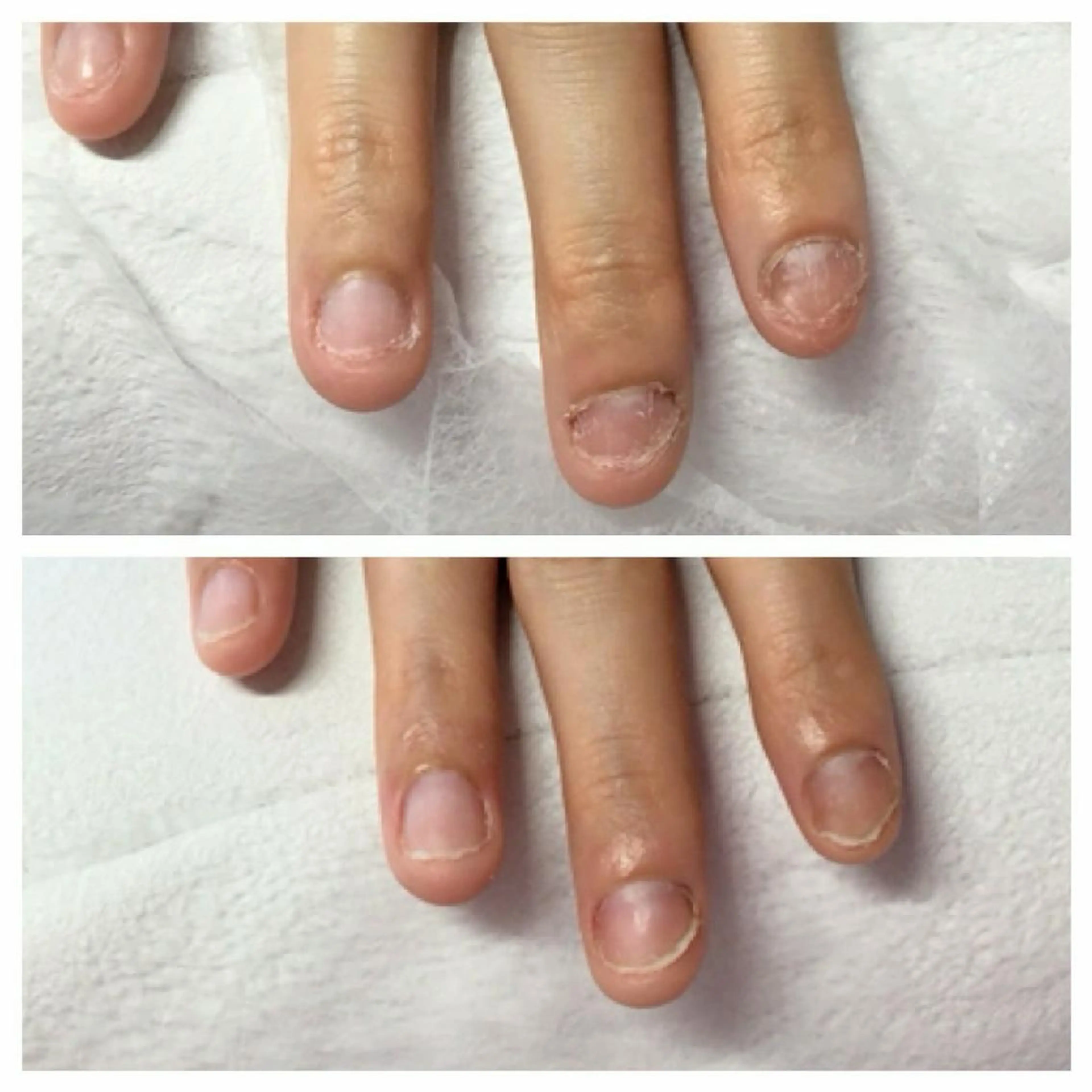 深爪・噛み癖ケアの写真