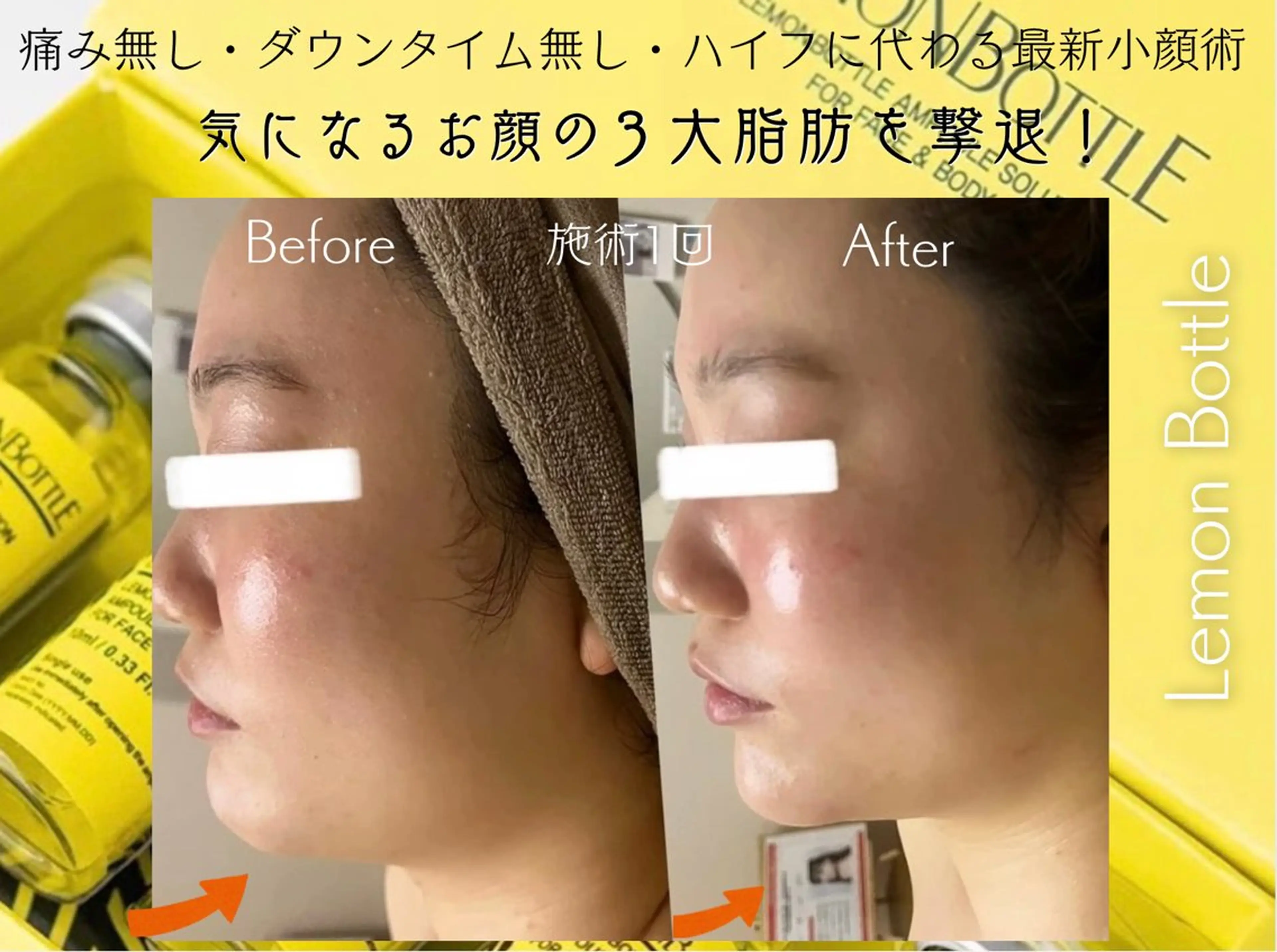 予約殺到✨次世代お顔のダイエット！話題の《レモン/ボトル🍋》4cc❗️口コミ必須🙏現金払いの写真