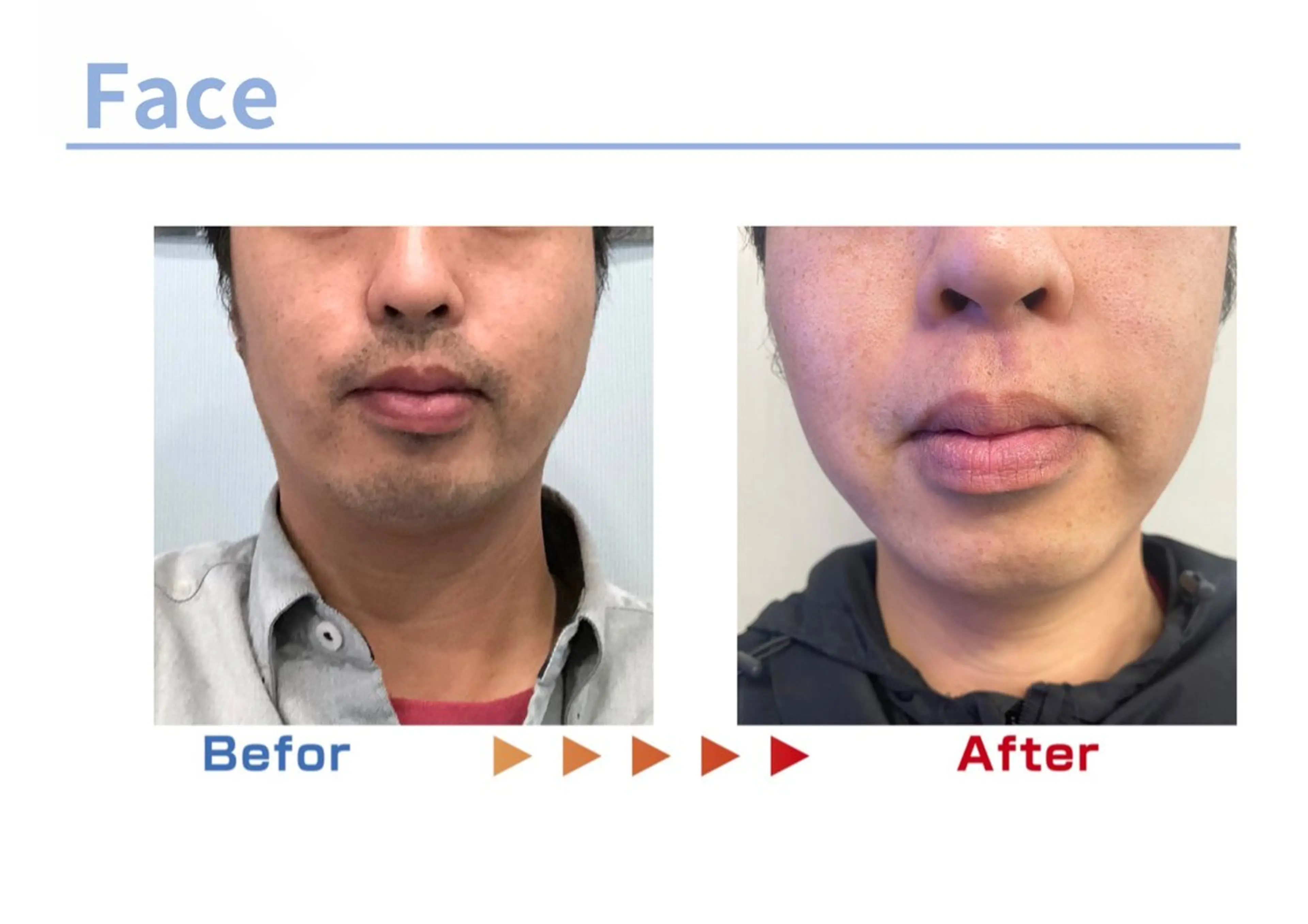 メンズ セルフ脱毛/美尻イス キングスサロン熊本のエステ・リラクイメージ