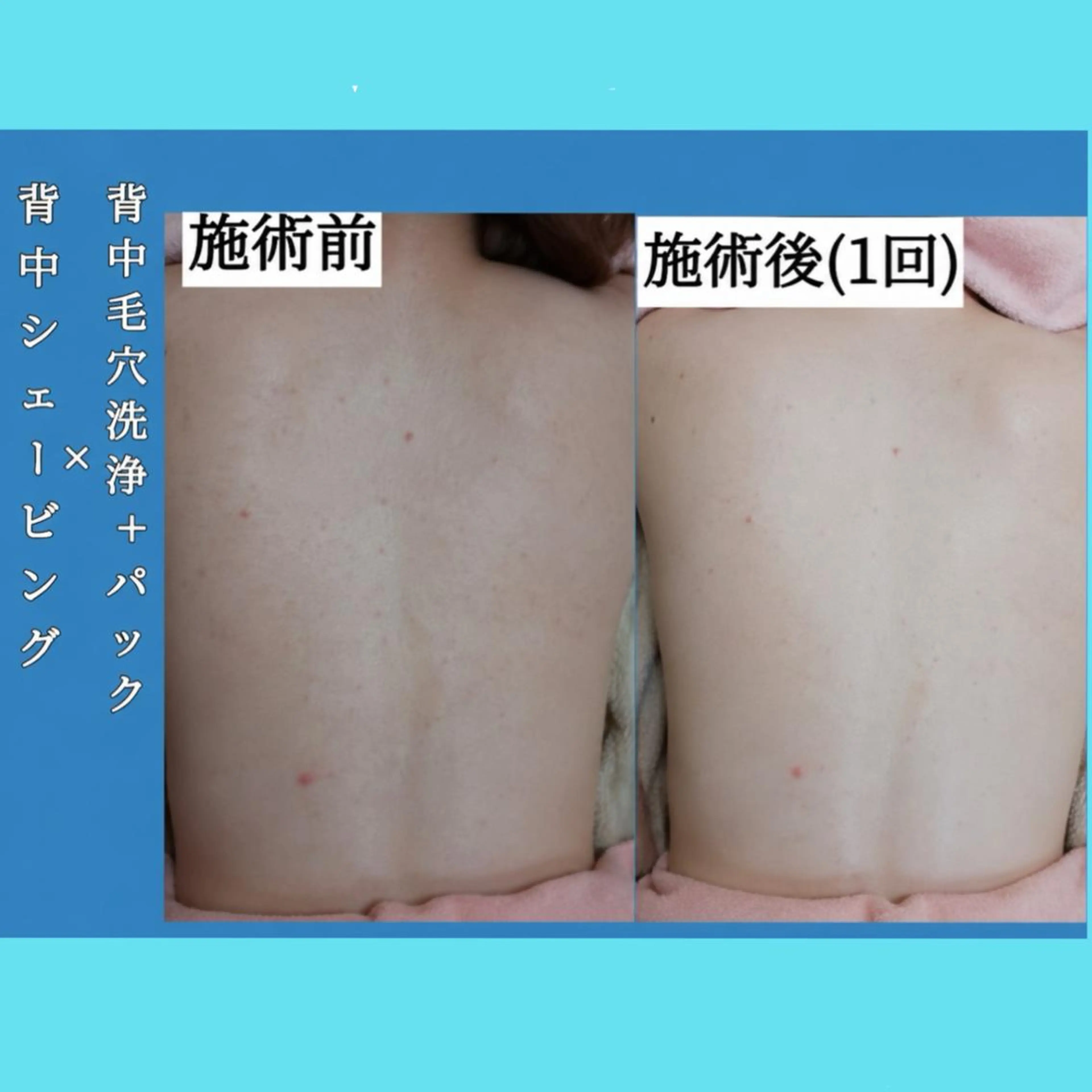 【背中シェービング×毛穴洗浄】夏までに肌ケア(4step)電気シェーバー処理+毛穴洗浄吸引+パック¥6500の写真