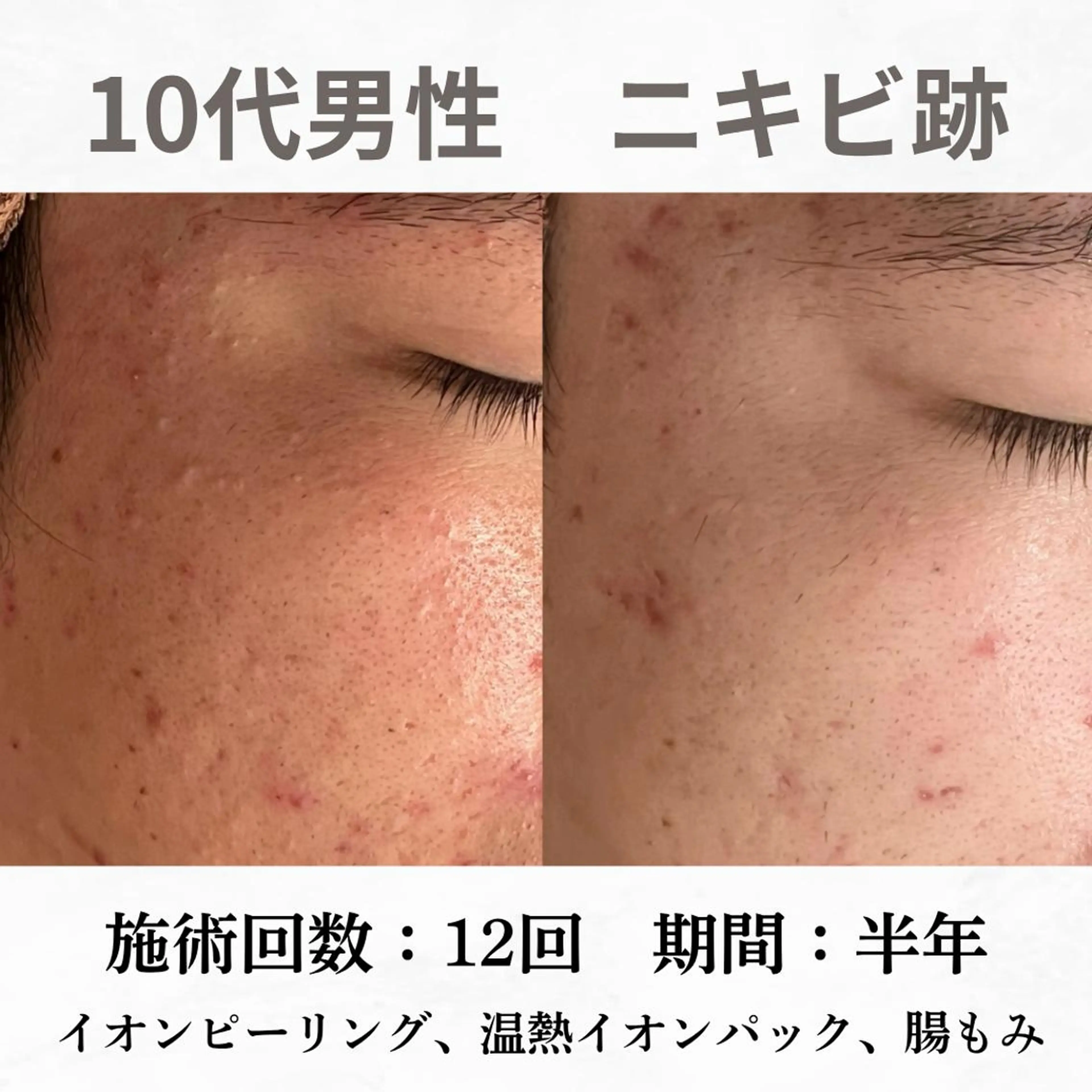 重度ニキビ専門🌷 ダウンタイムなしのエステ・リラクイメージ