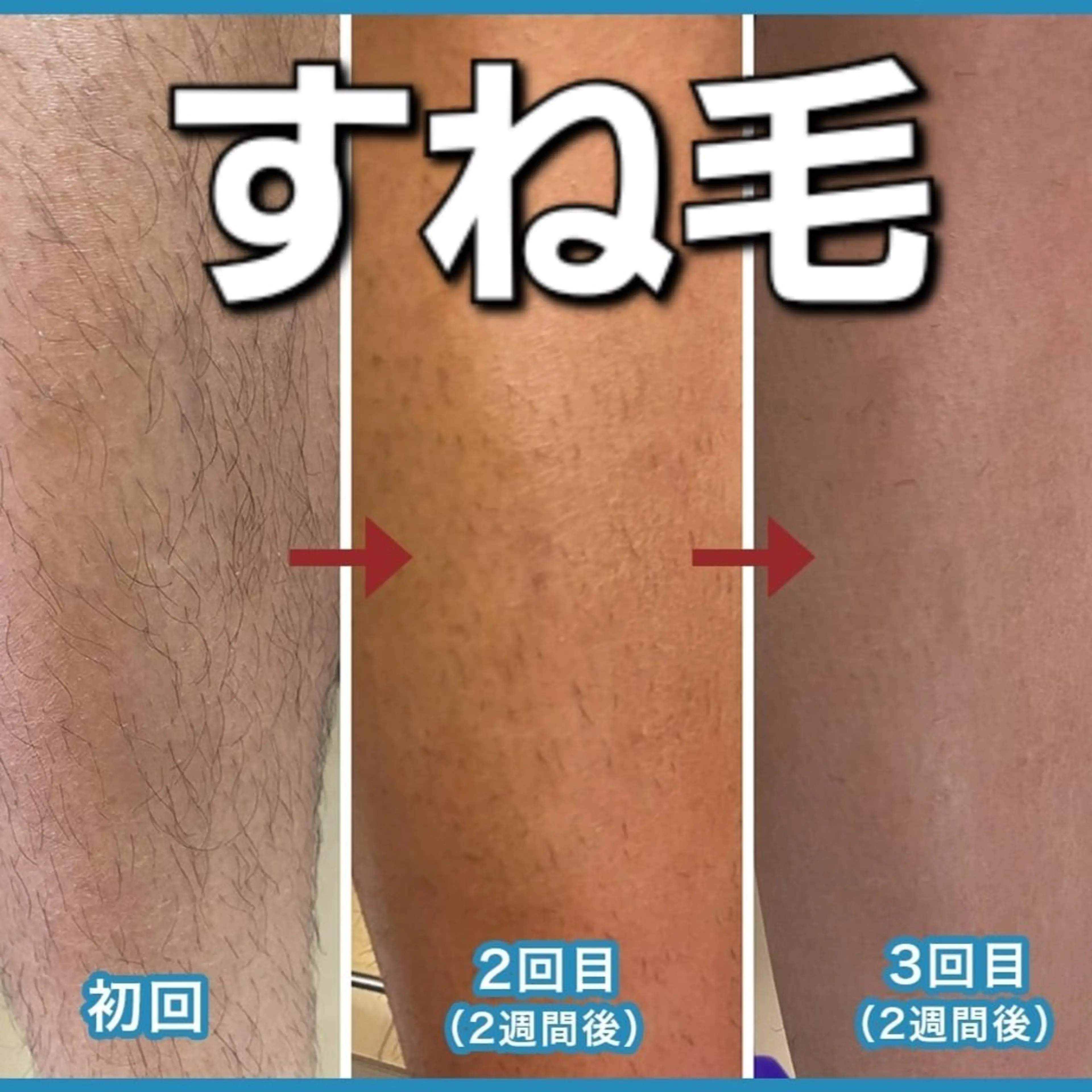 メンズ　両足脱毛　初回来店限定価格50%OFFの写真