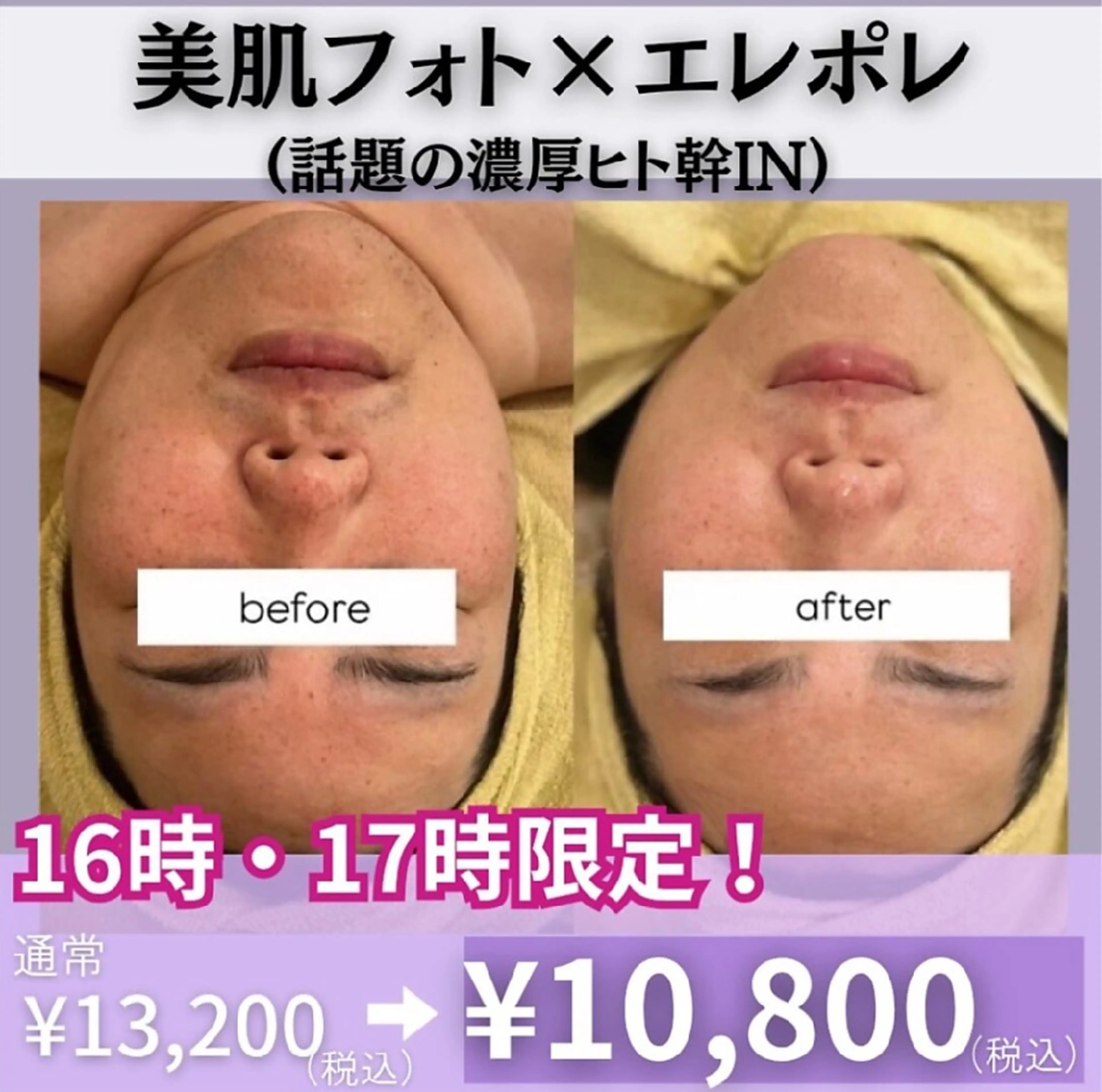 16.17時限定 隙間時間に肌改善美肌フォトxエレポレ＋ヒト幹¥13,200→¥10,800の写真