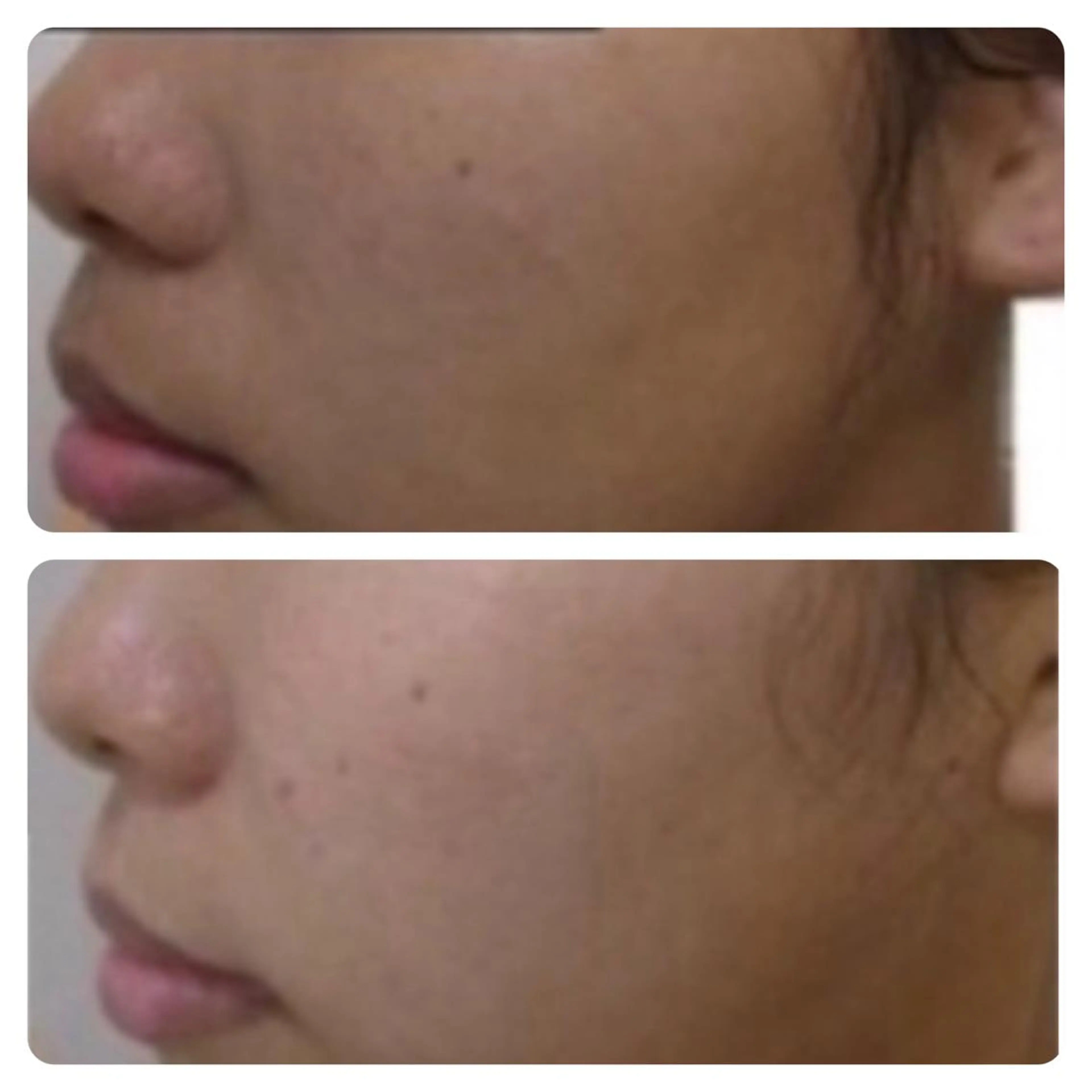 【くすみ撃退◎潤い美肌】肌診断+美白パック+リフトアップ+栄養導入 90分の写真