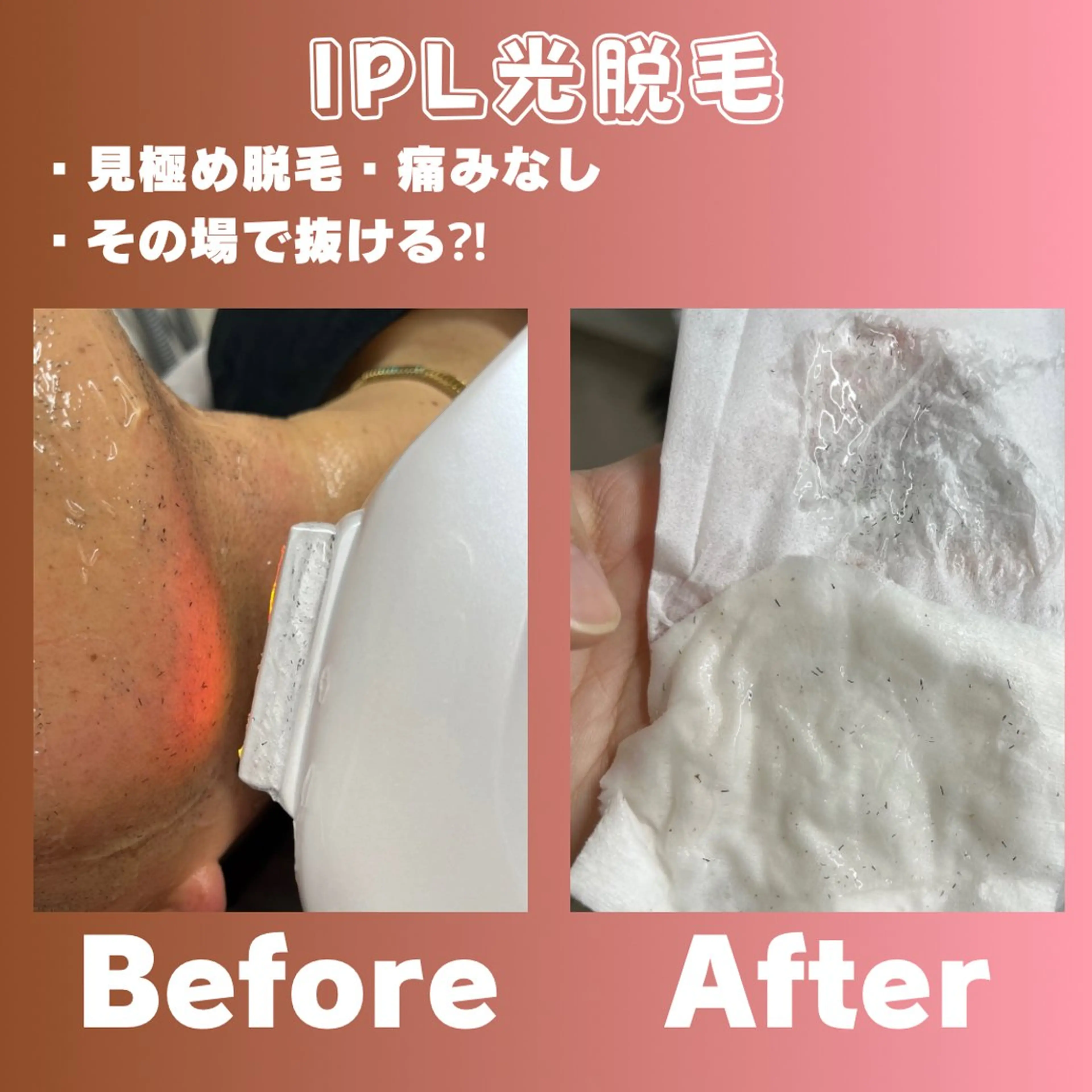 驚きの0円カウンセリング‼️追加料金無し。痛みのレベル確認に5回打ち★（お顔、腕、膝下のみ）の写真