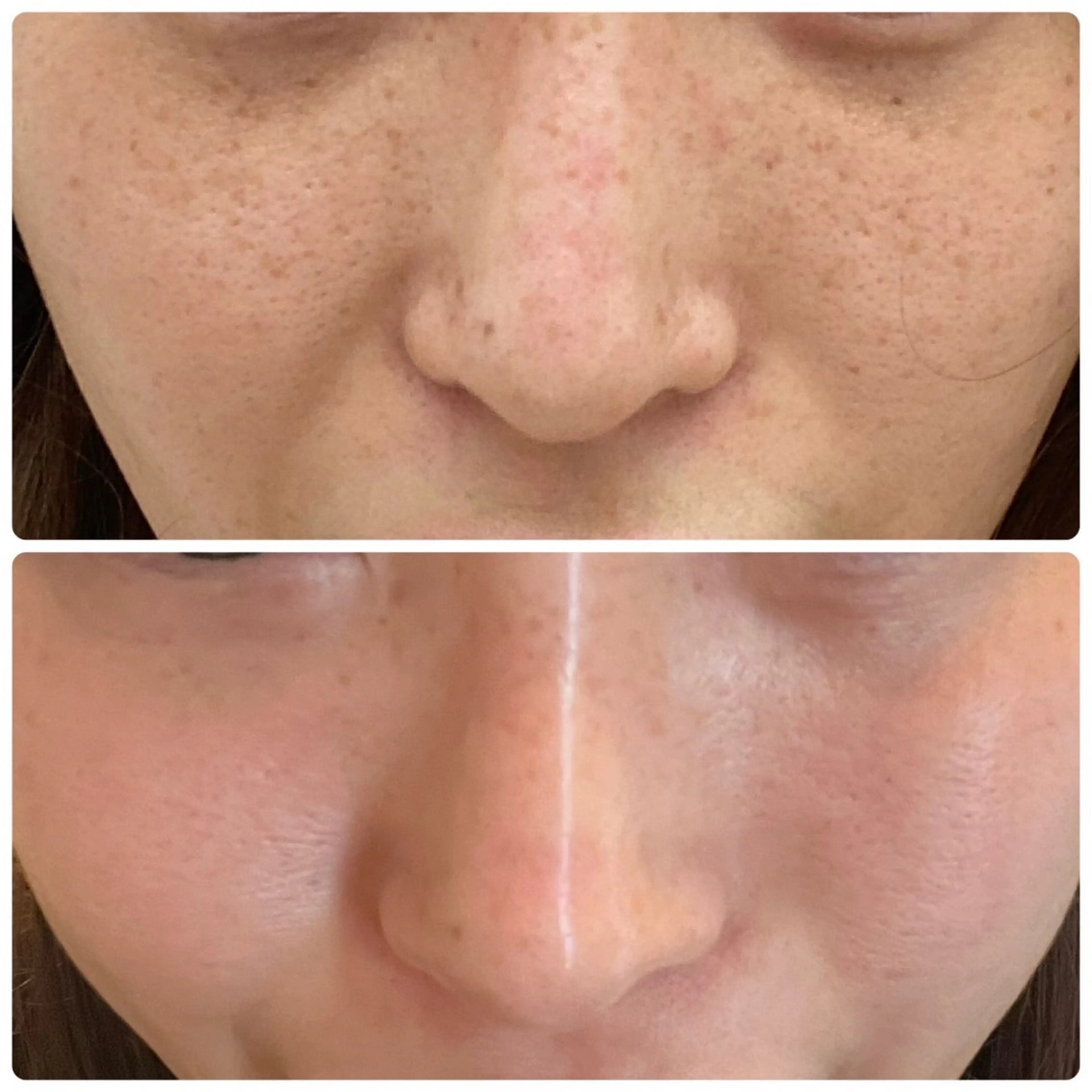 【圧倒的人気No1】ハリ•ツヤ•美白•赤ちゃん肌/REVIハーブピーリング/まずはお試し20000円→8800円の写真