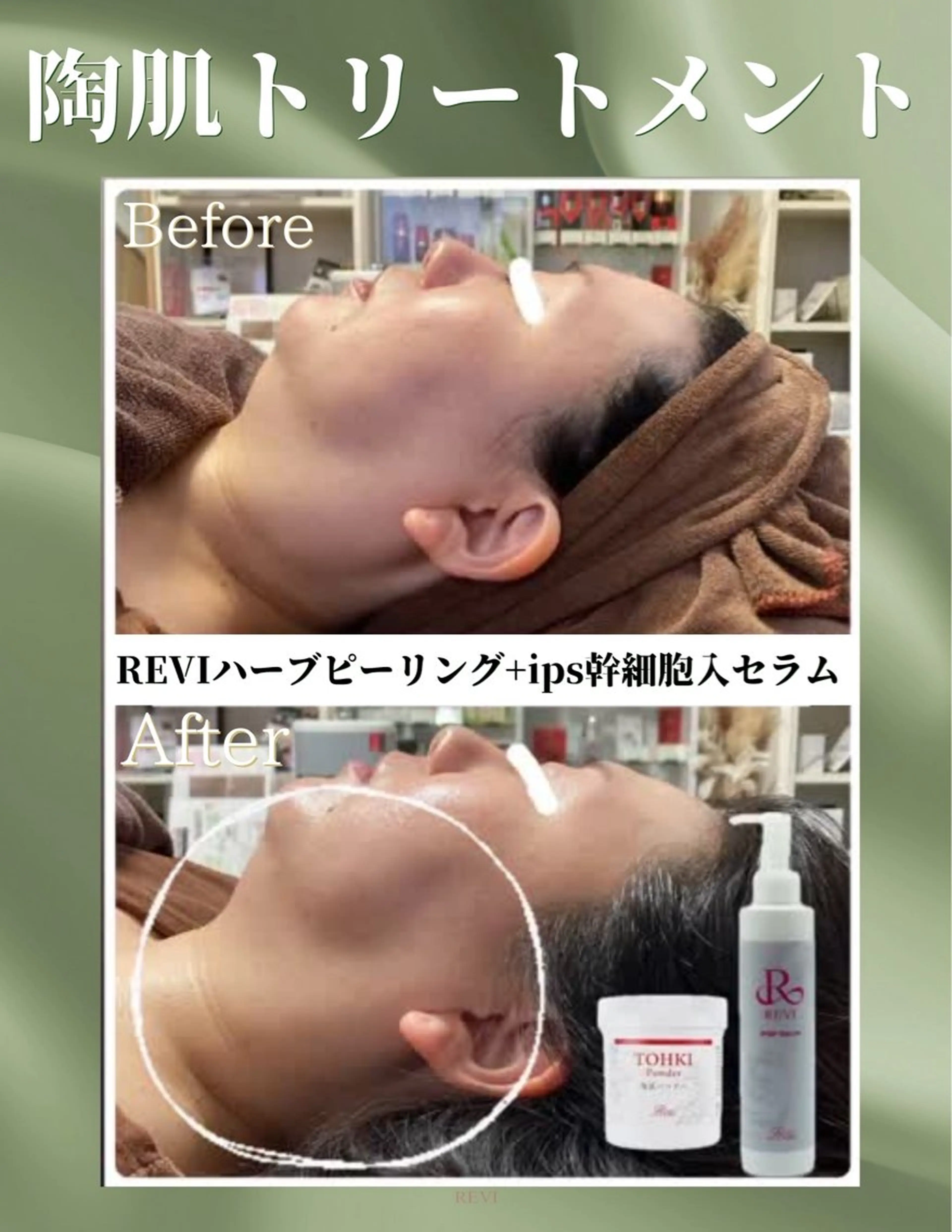 オープン記念♪REVI陶肌トリートメント2g（剥けないハーブピーリング）+IPSP幹細胞入セラムの写真