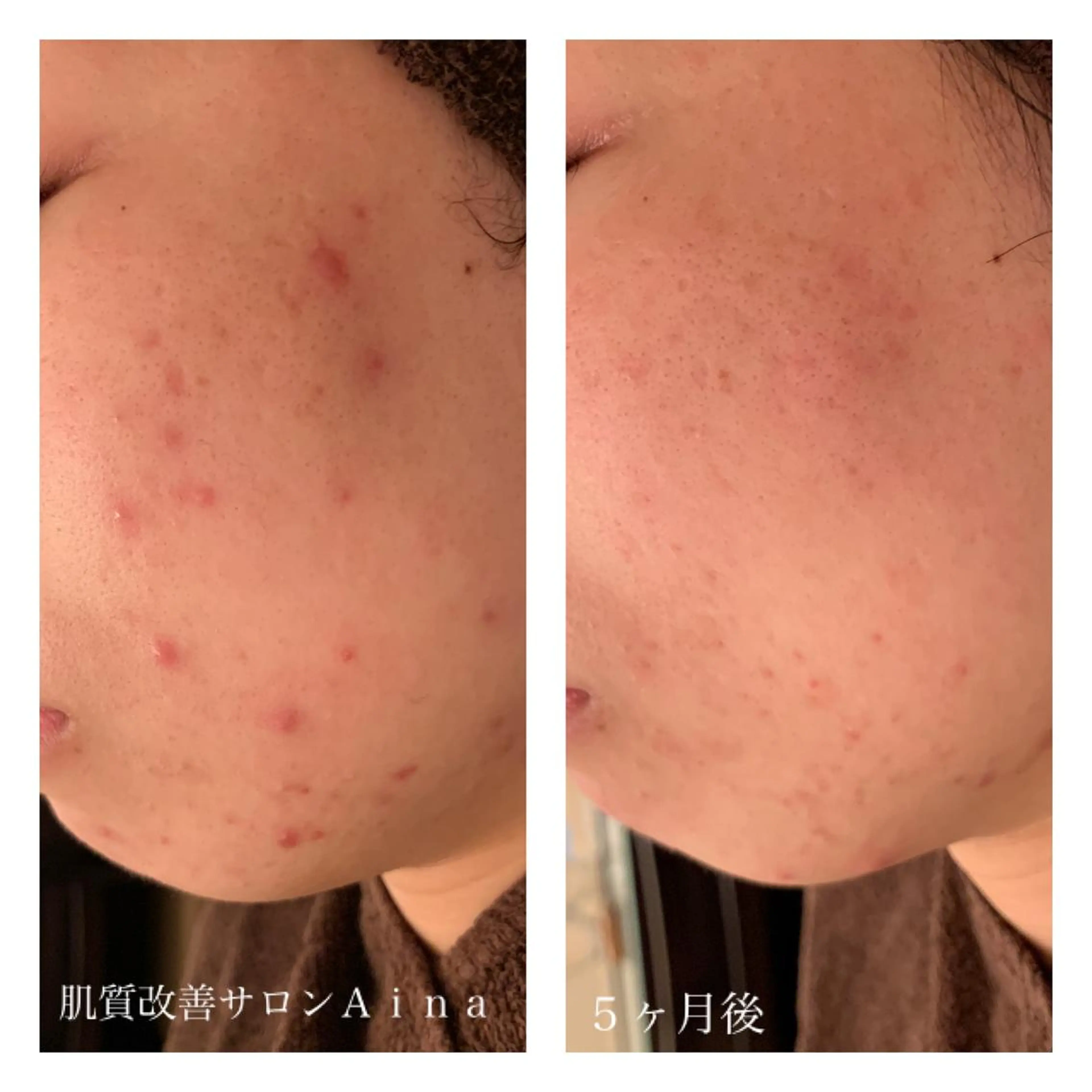 ミディアム カラー パーマ ヘアアレンジ メンズ キッズ ネイル マツエク・マツパ 赤色 ニキビ跡専門サロン Ａｉｎａのエステ・リラクイメージ