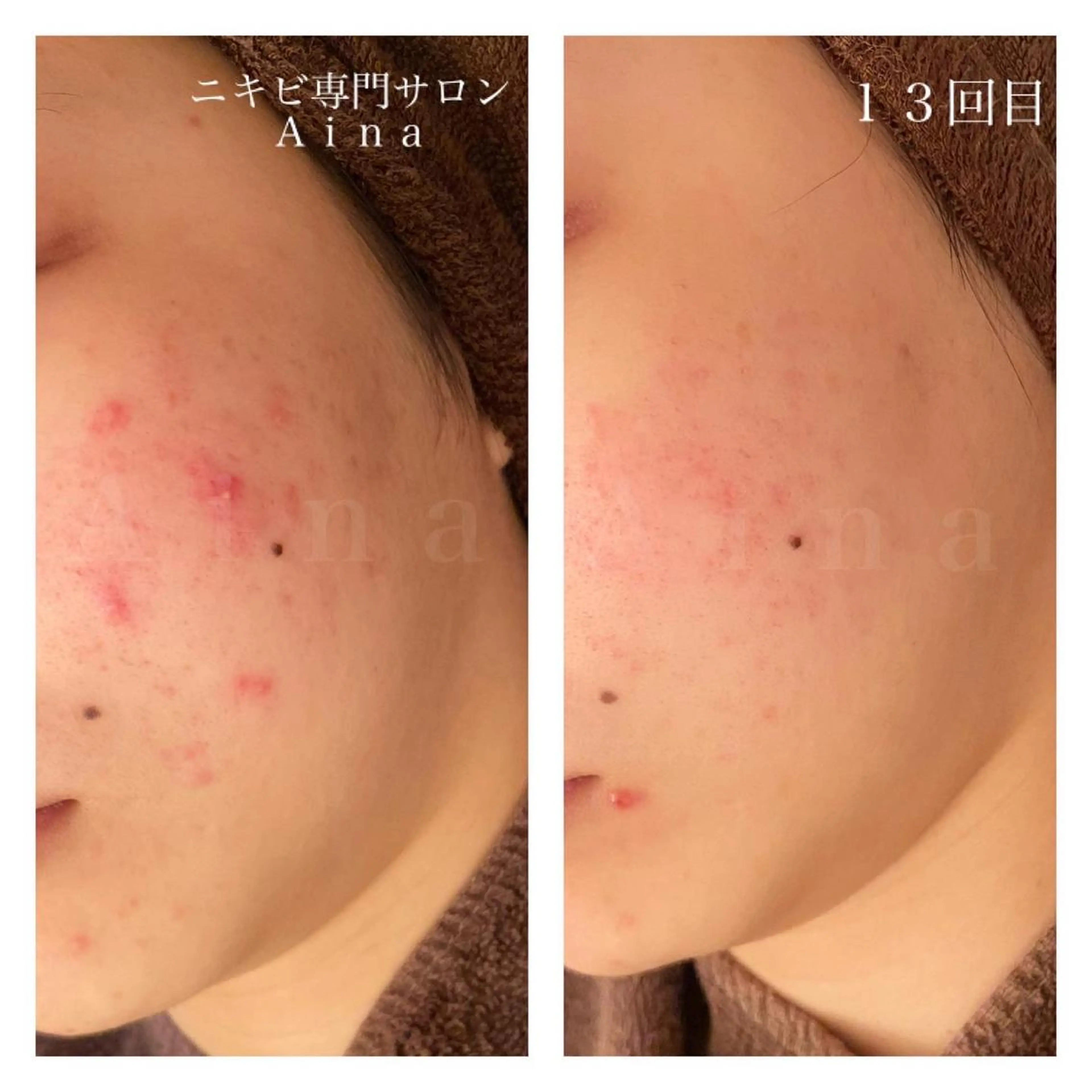 セミロング カラー パーマ ヘアアレンジ メンズ キッズ ネイル マツエク・マツパ エステ リラク ニキビ跡専門サロン Ainaのエステ・リラクイメージ