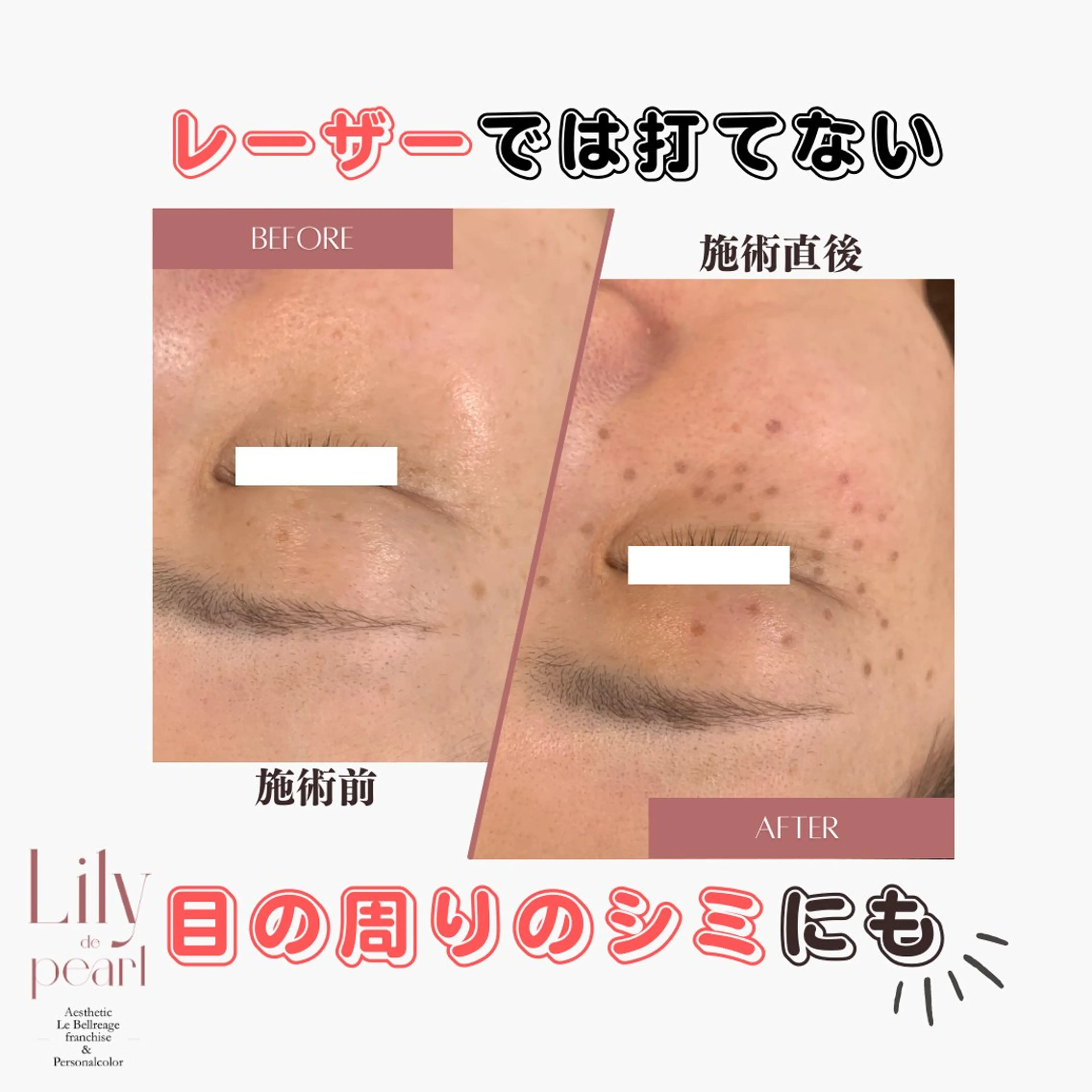 エステ 最新シミケアLily de pearlのエステ・リラクイメージ