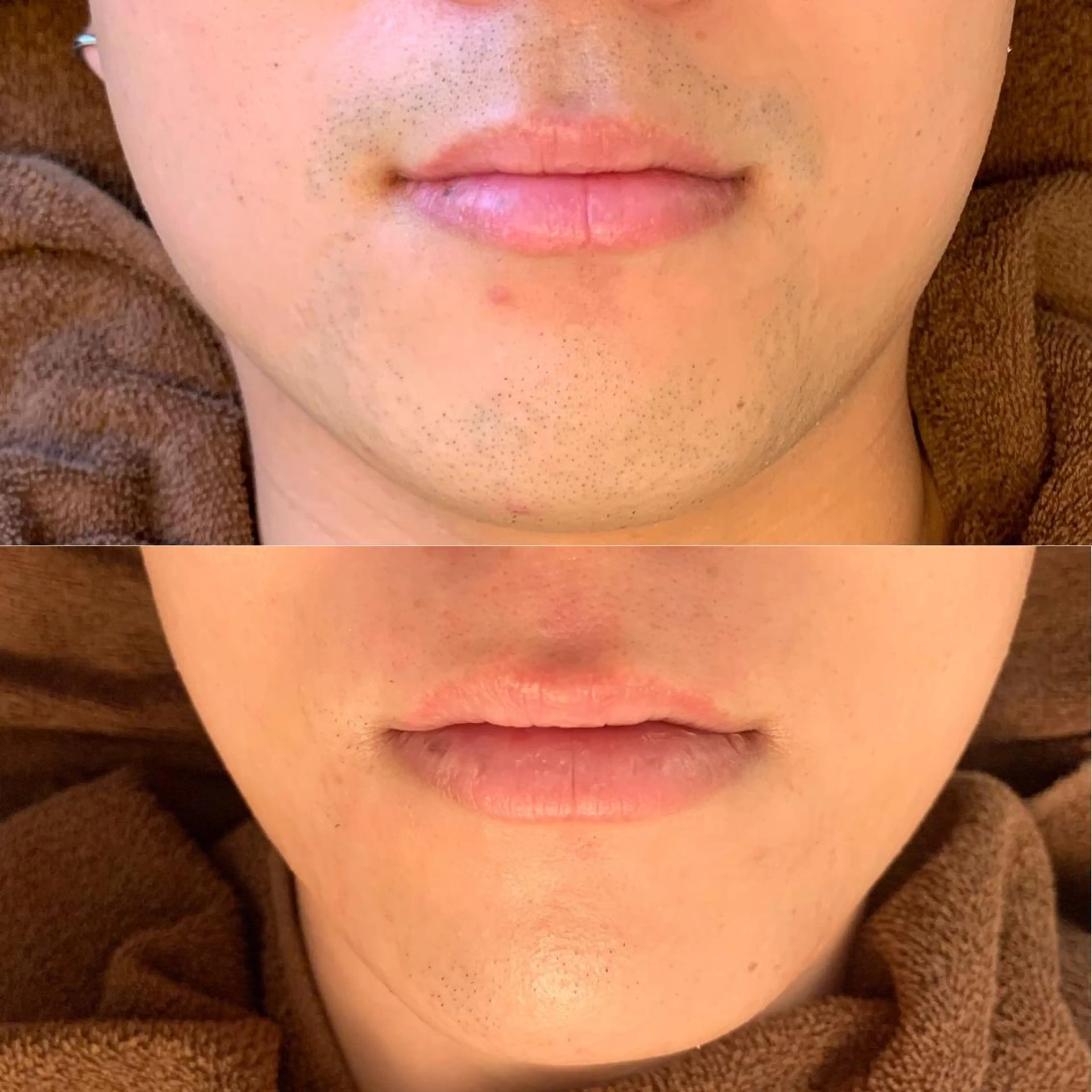 メンズ【ひげ脱毛】¥7700→¥3500［メンズ脱毛/横浜/ヒゲ脱毛］の写真