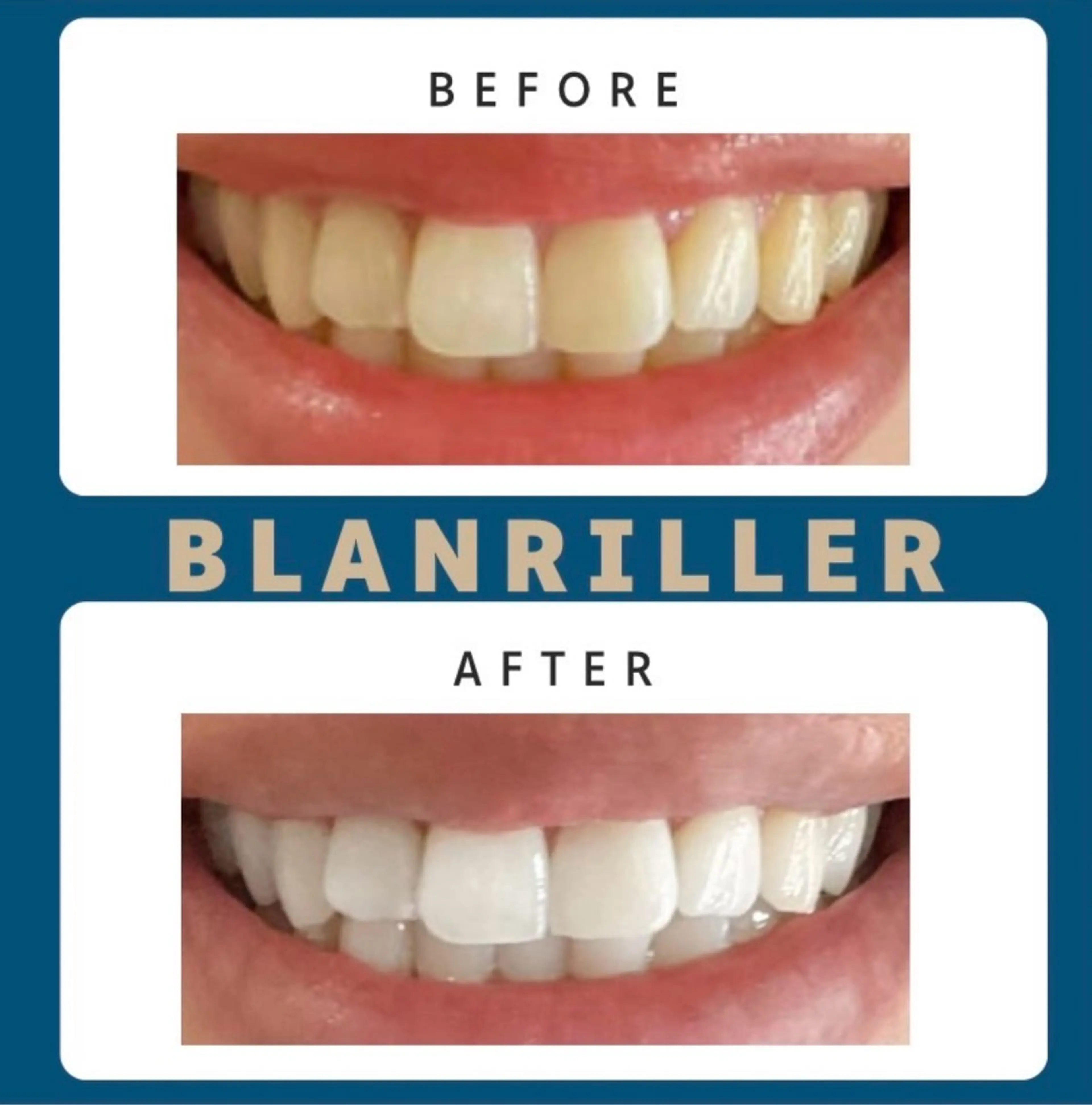 前回ご来店から1ヶ月以内のご予約で20%オフ❤️セルフホワイトニング15分×2回(30分照射)¥5000→¥4000🎶の写真