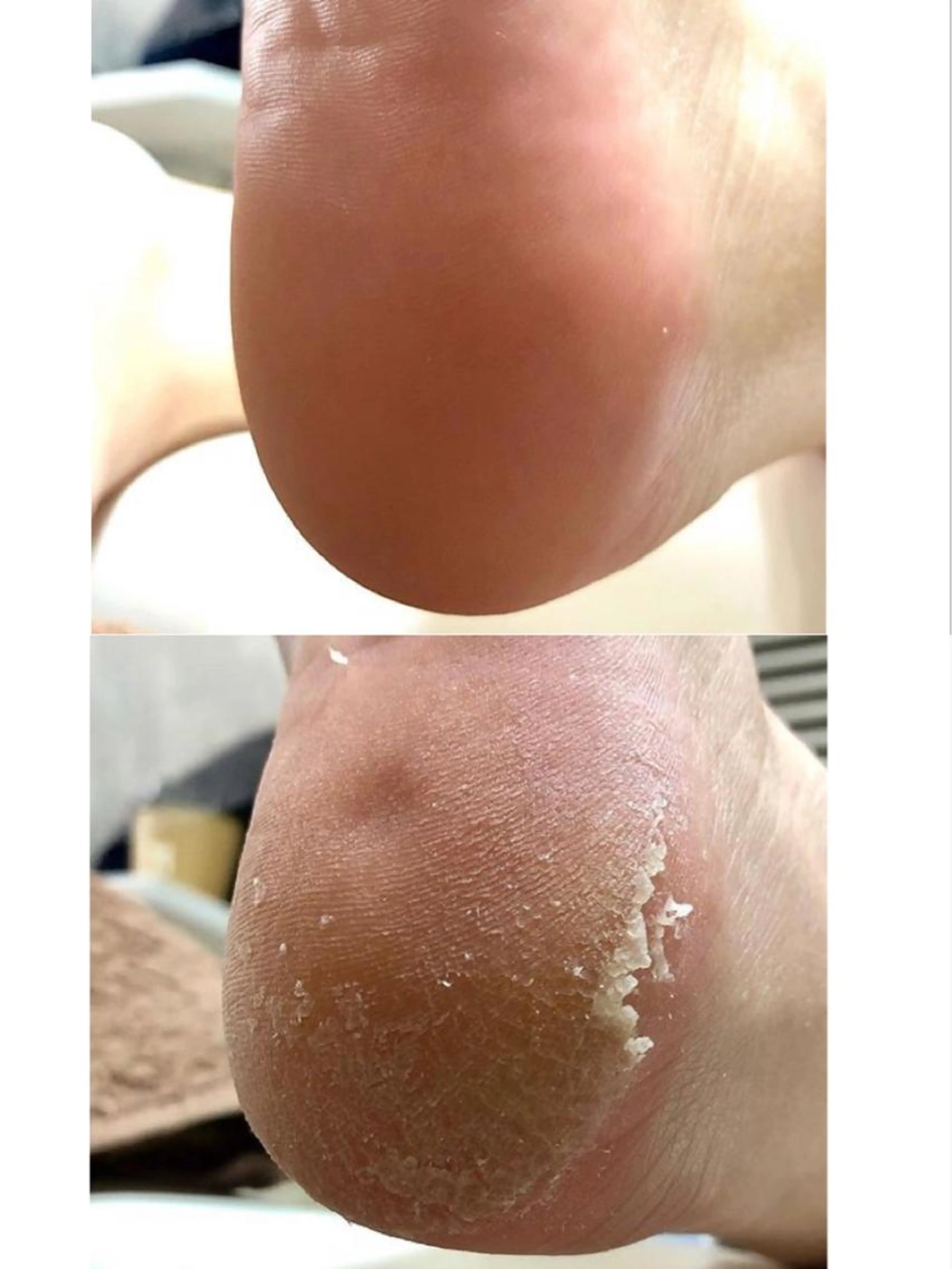 フットケア(角質込み)の写真