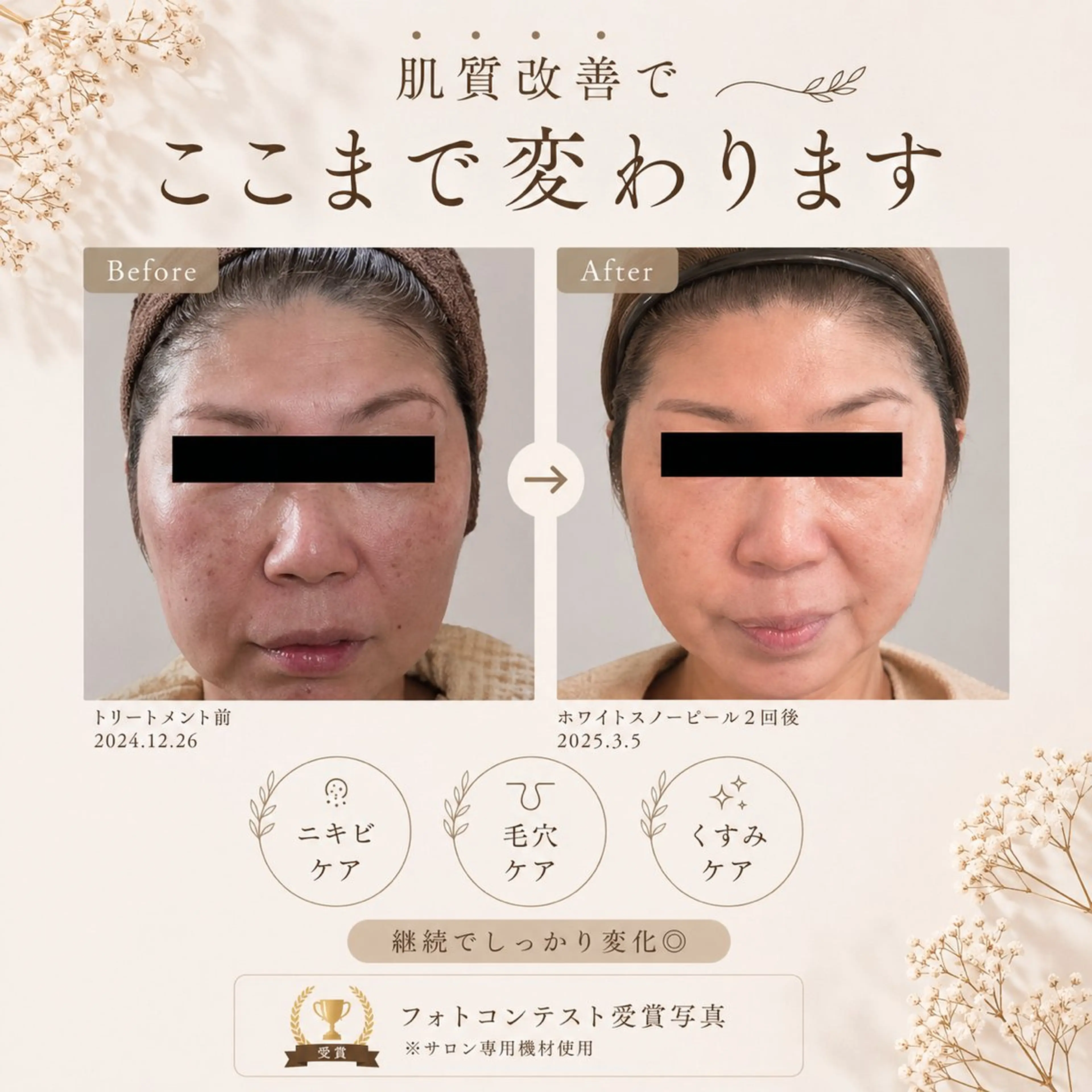 エステ ピーリングケア 🤍moekoのエステ・リラクイメージ