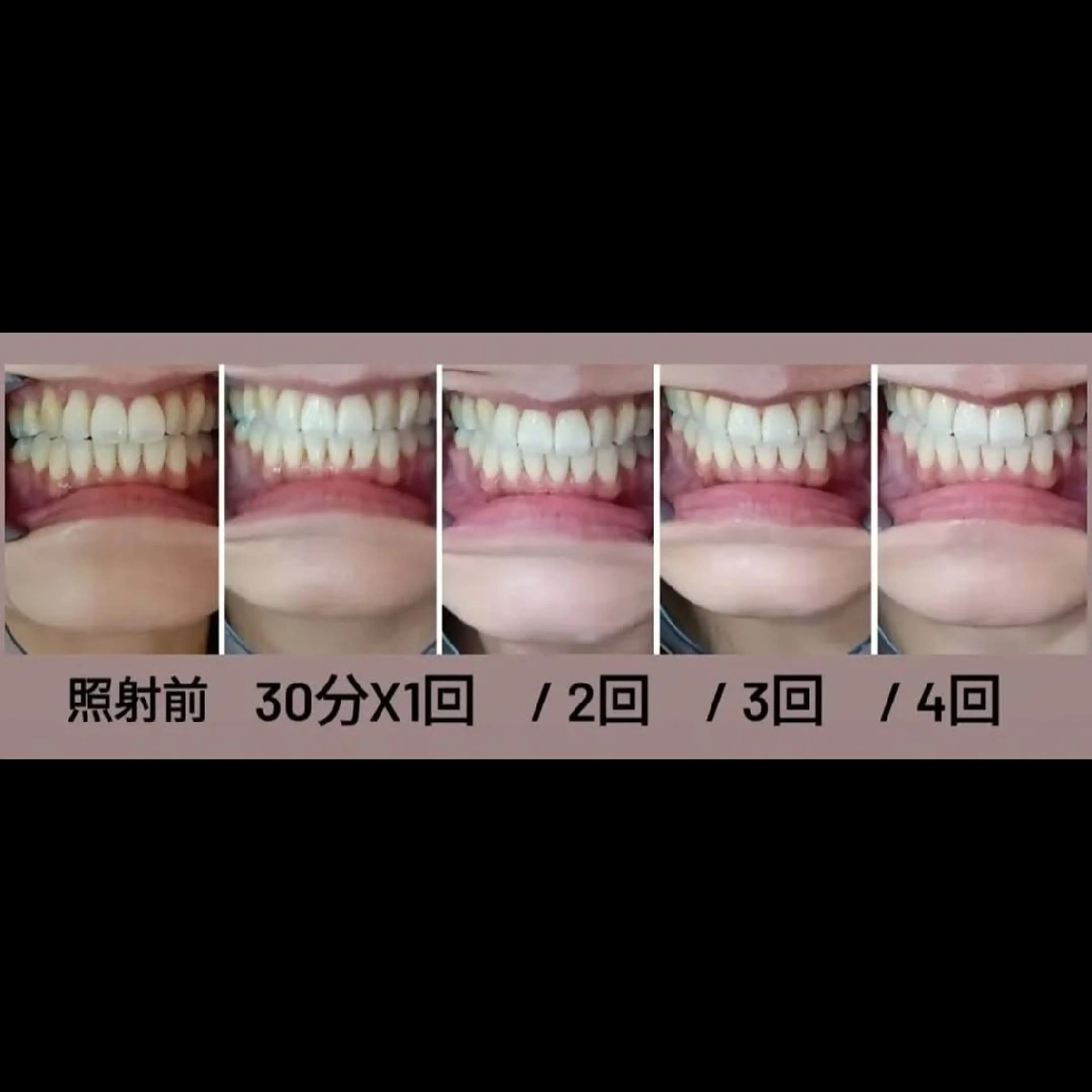 【 1回30分あたり/¥3,571 】セルフホワイトニング回数券　７回の写真