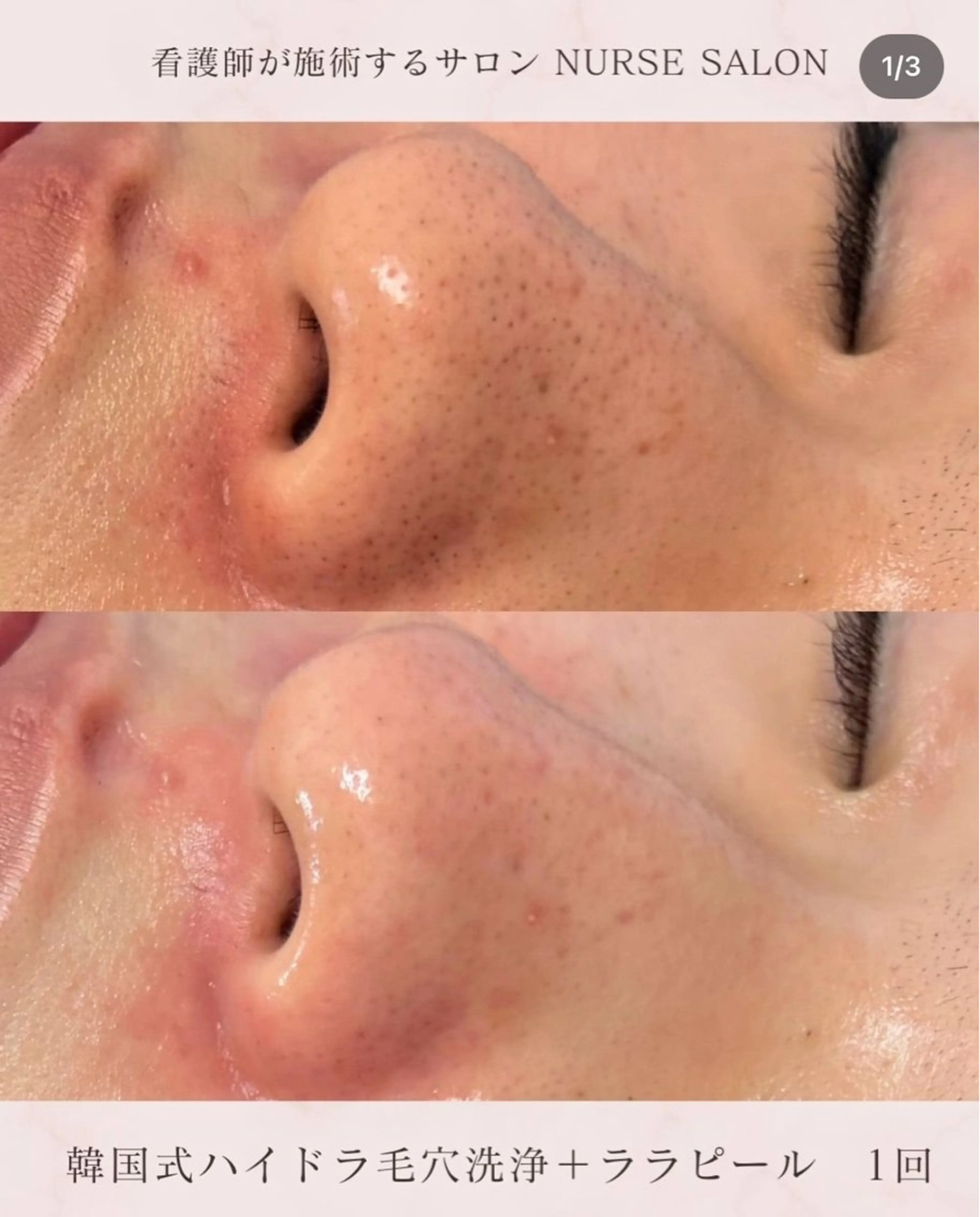 美肌・小顔専門🪄 看護師施術/松﨑のエステ・リラクイメージ