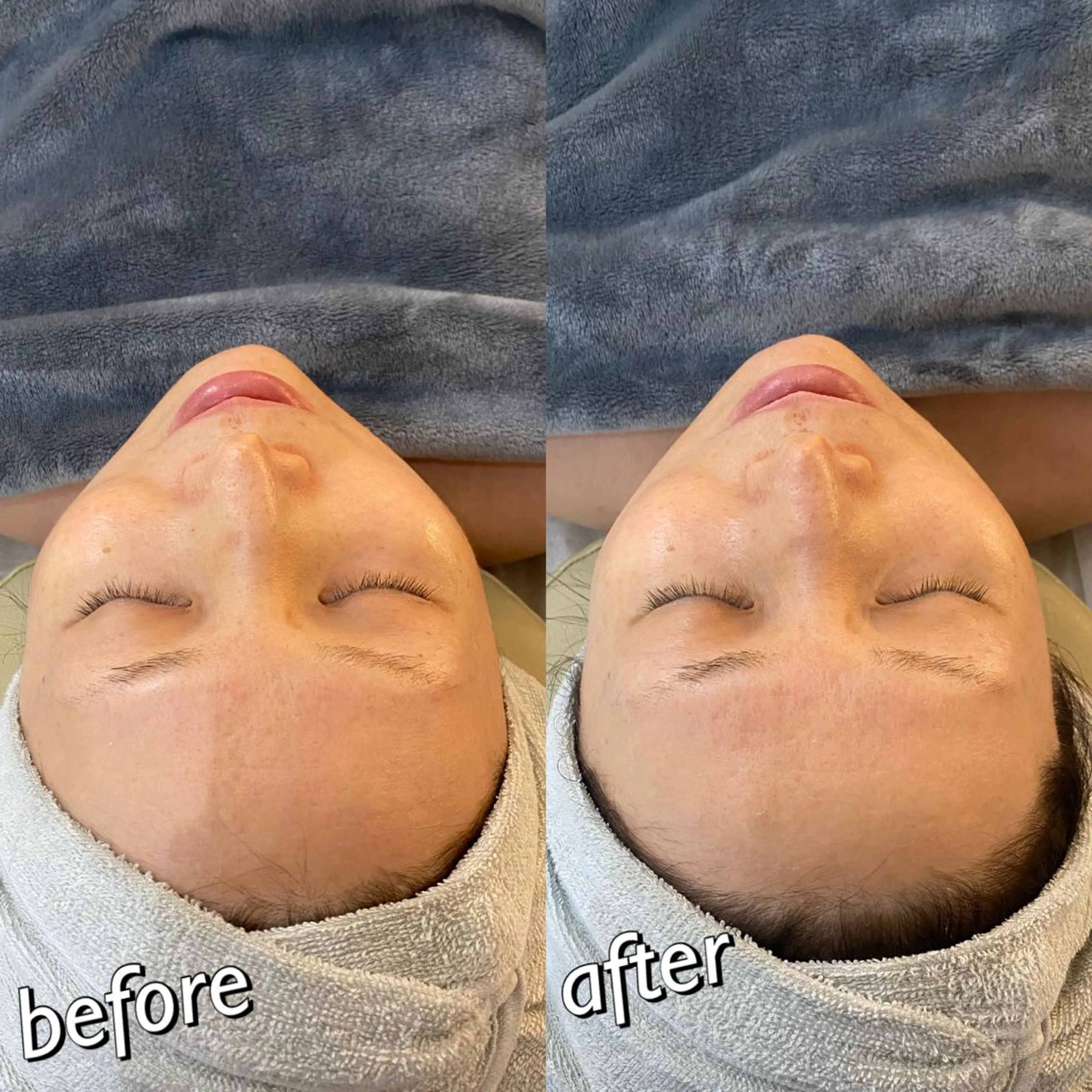 うなじ脱毛/美肌脱毛 LABELのエステ・リラクイメージ