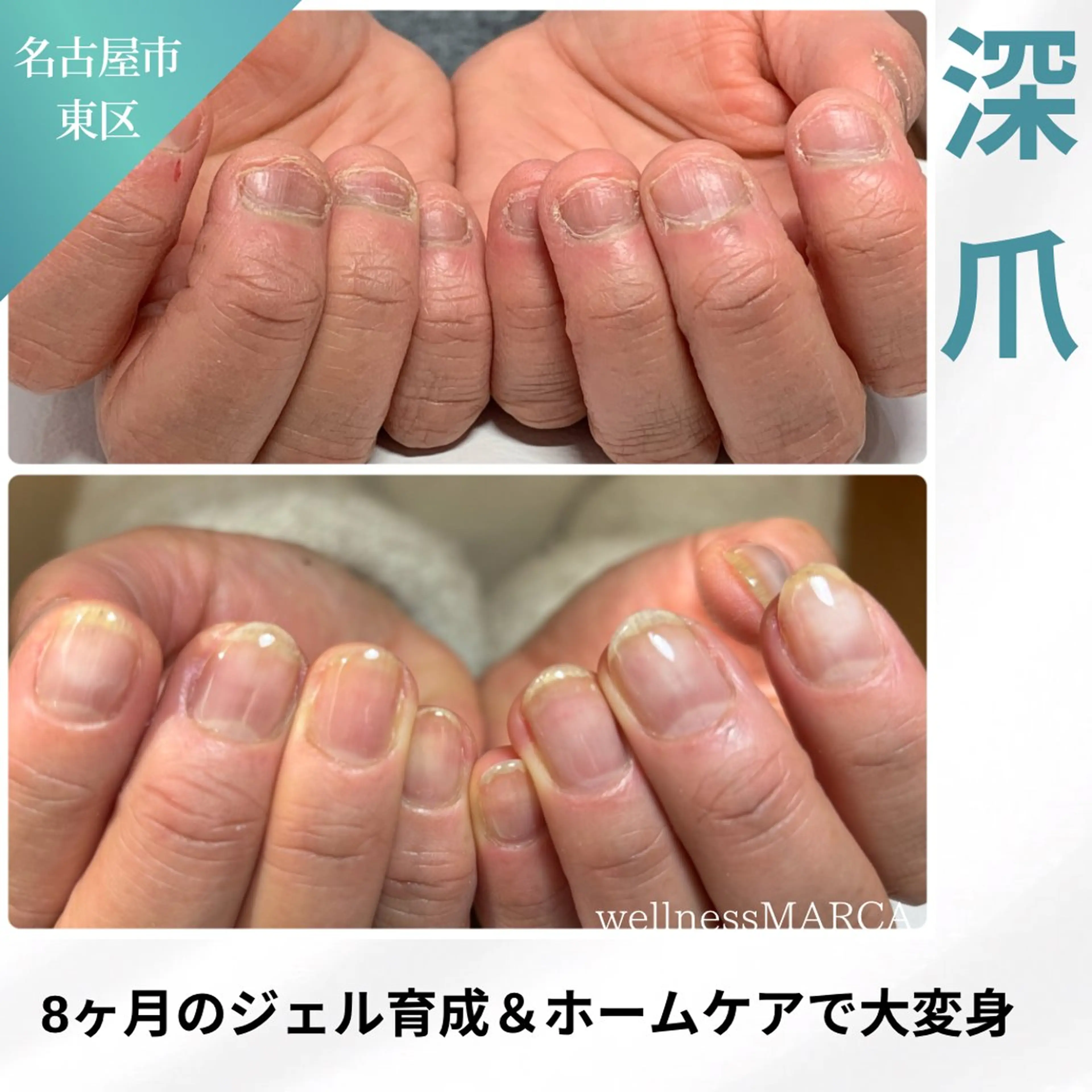 深爪矯正（メンズOK）の写真