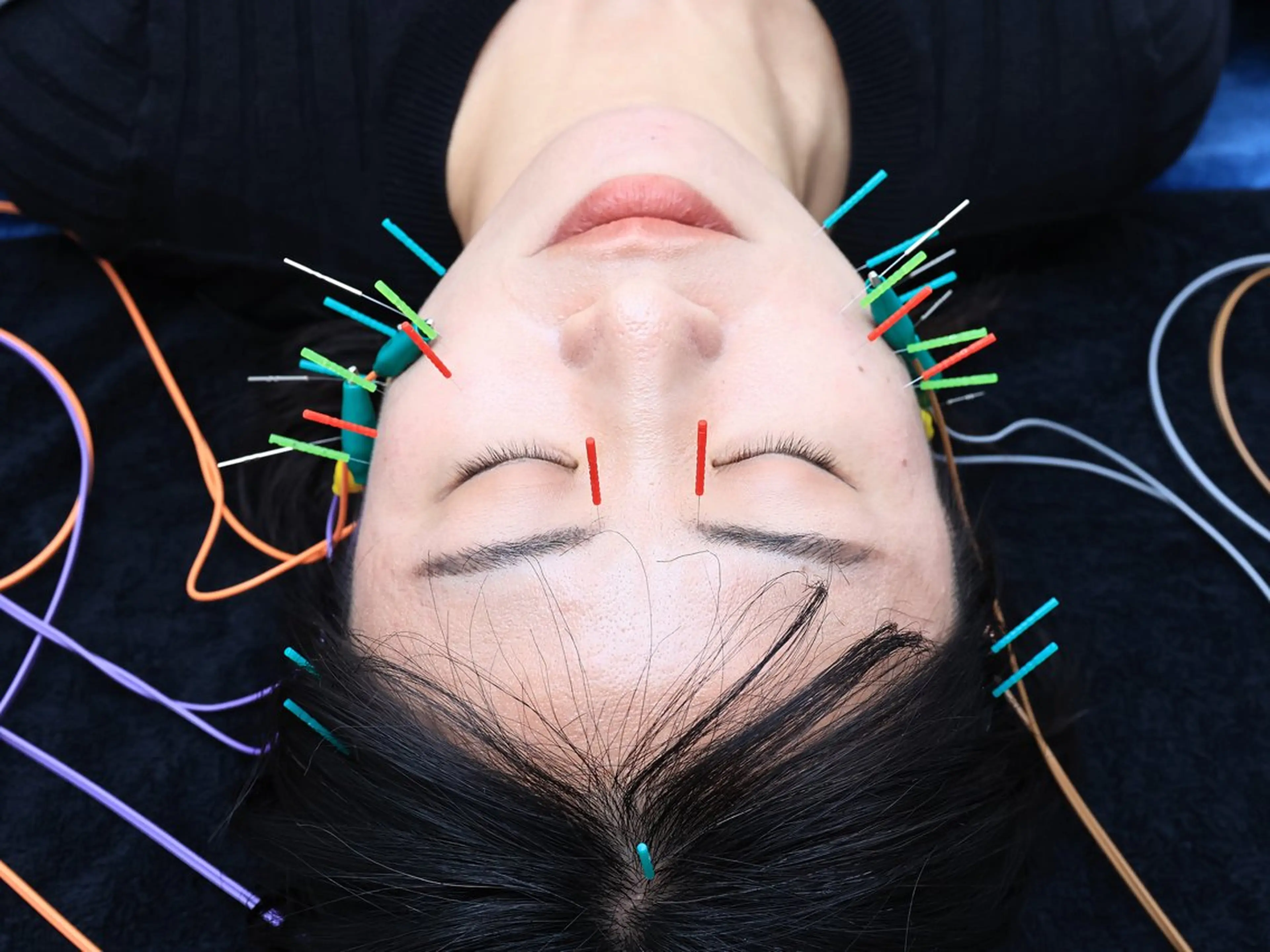 美容鍼・小顔矯正 FLOW 鍼灸整体院のその他イメージ