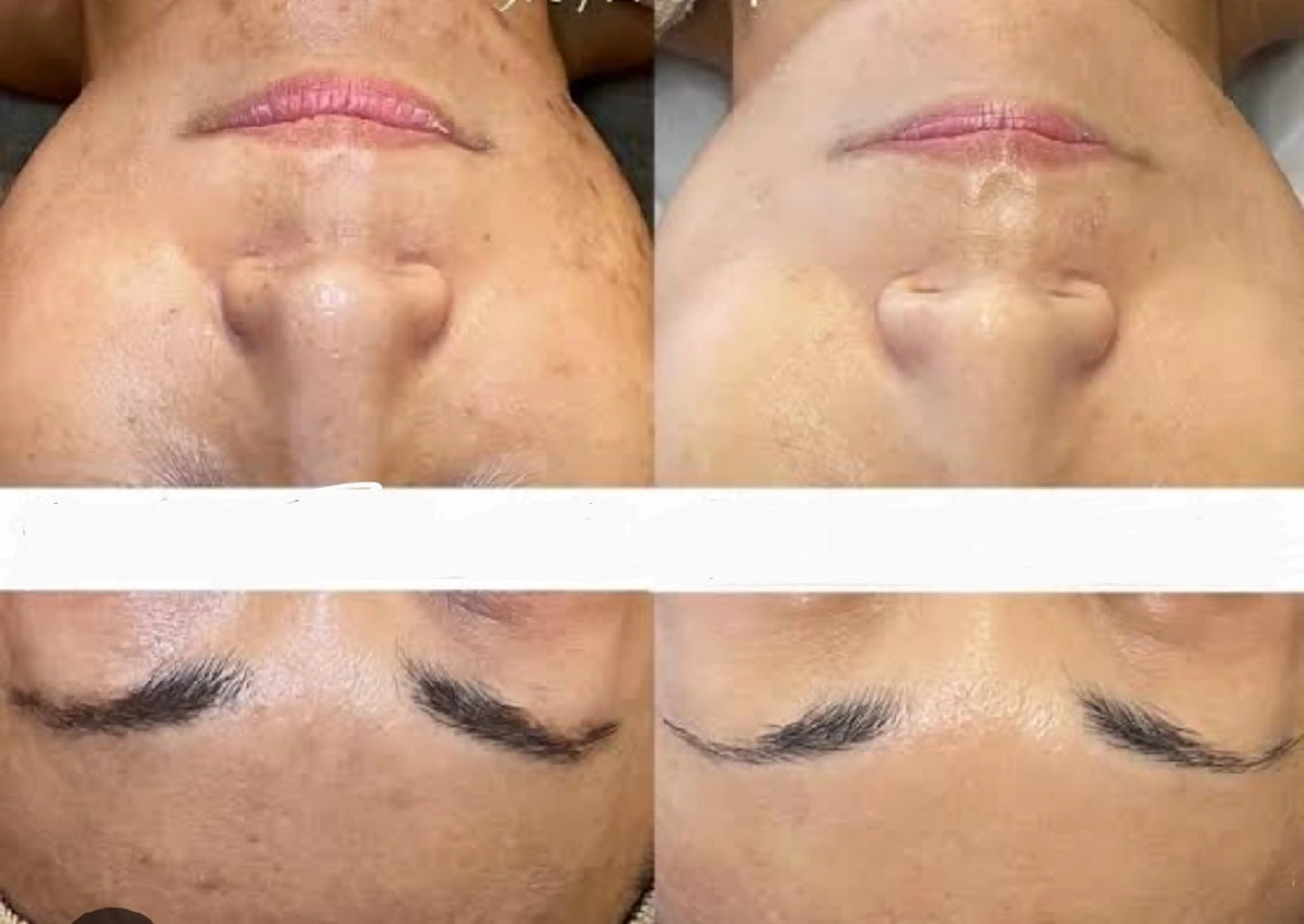 エステ 肌質改善BIOELプ ラズマ/ラミピールのエステ・リラクイメージ