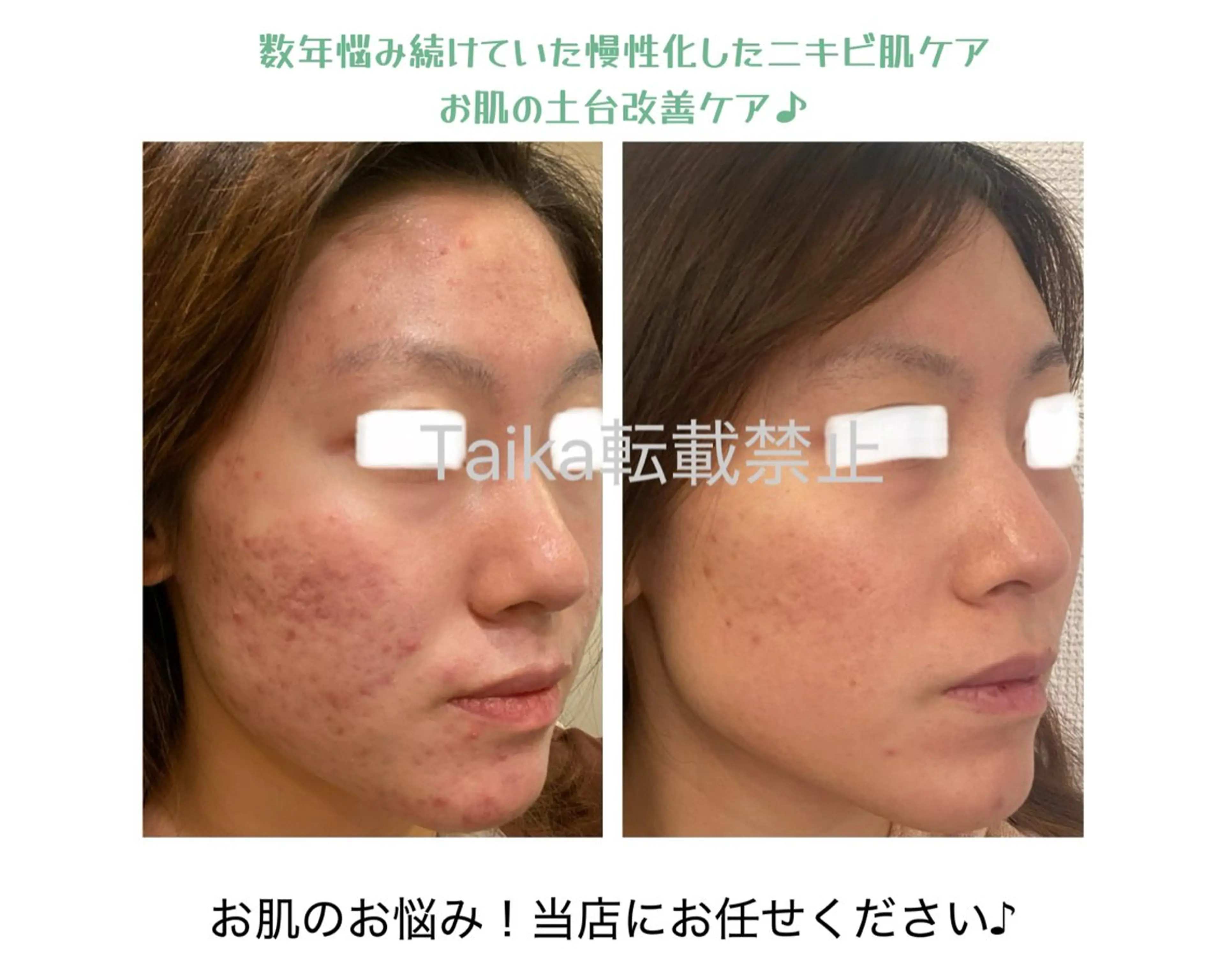 ニキビ肌ケア特化ピーリング♪の写真