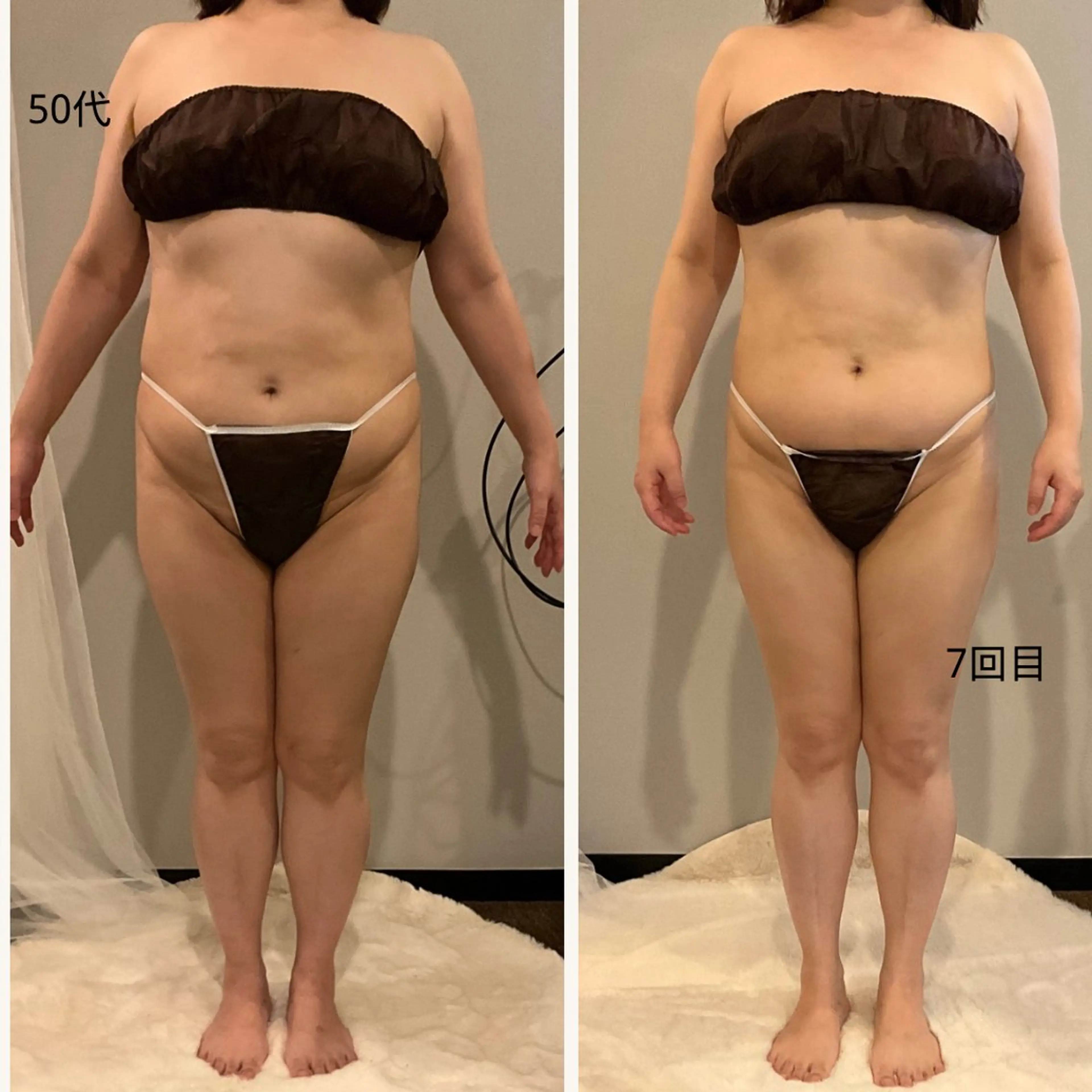 [お腹+二の腕+背中]ハイパーナイフEx+マッサージコース60分の写真