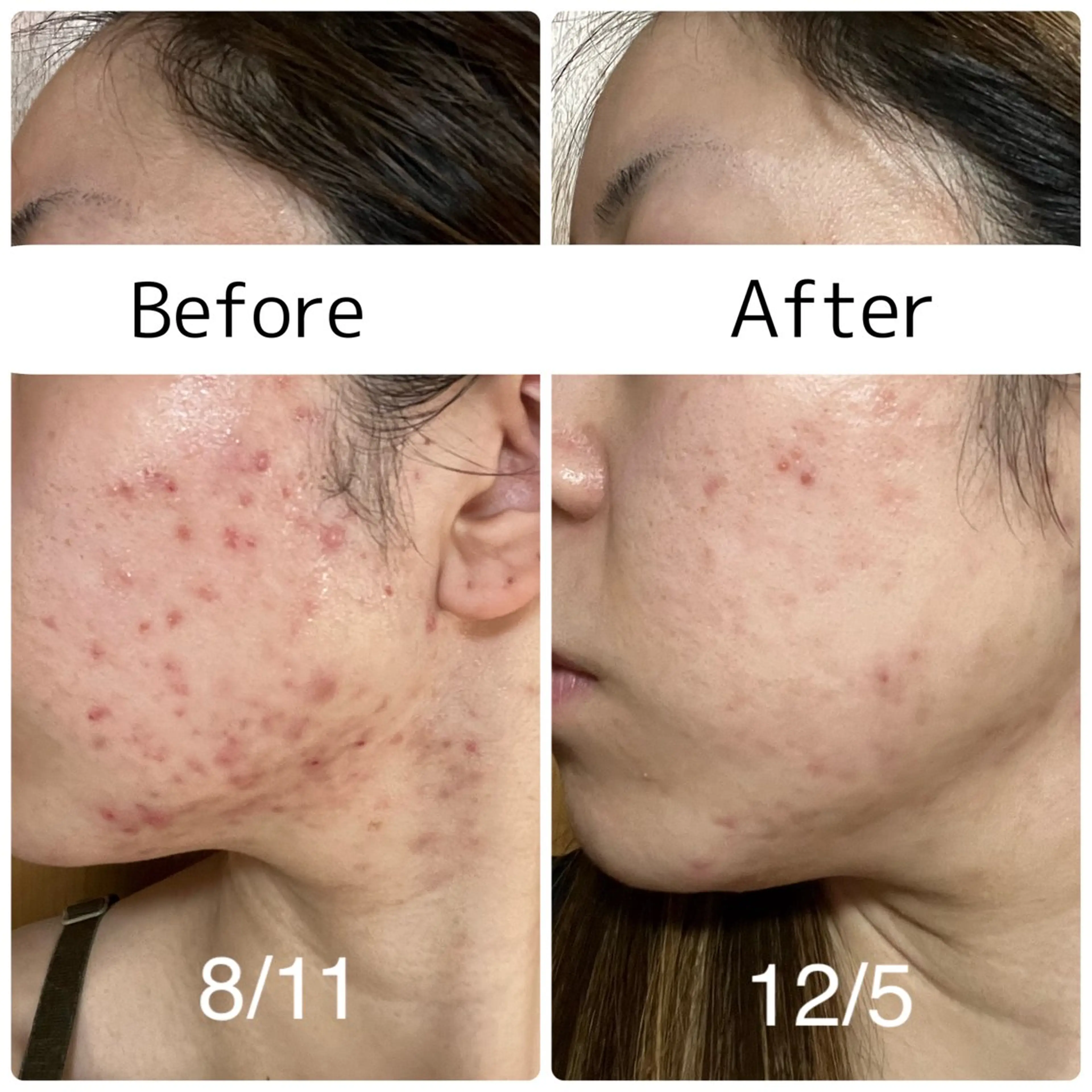 ミニモ限定特別価格🔥🔥【ニキビ撃退コース】の写真