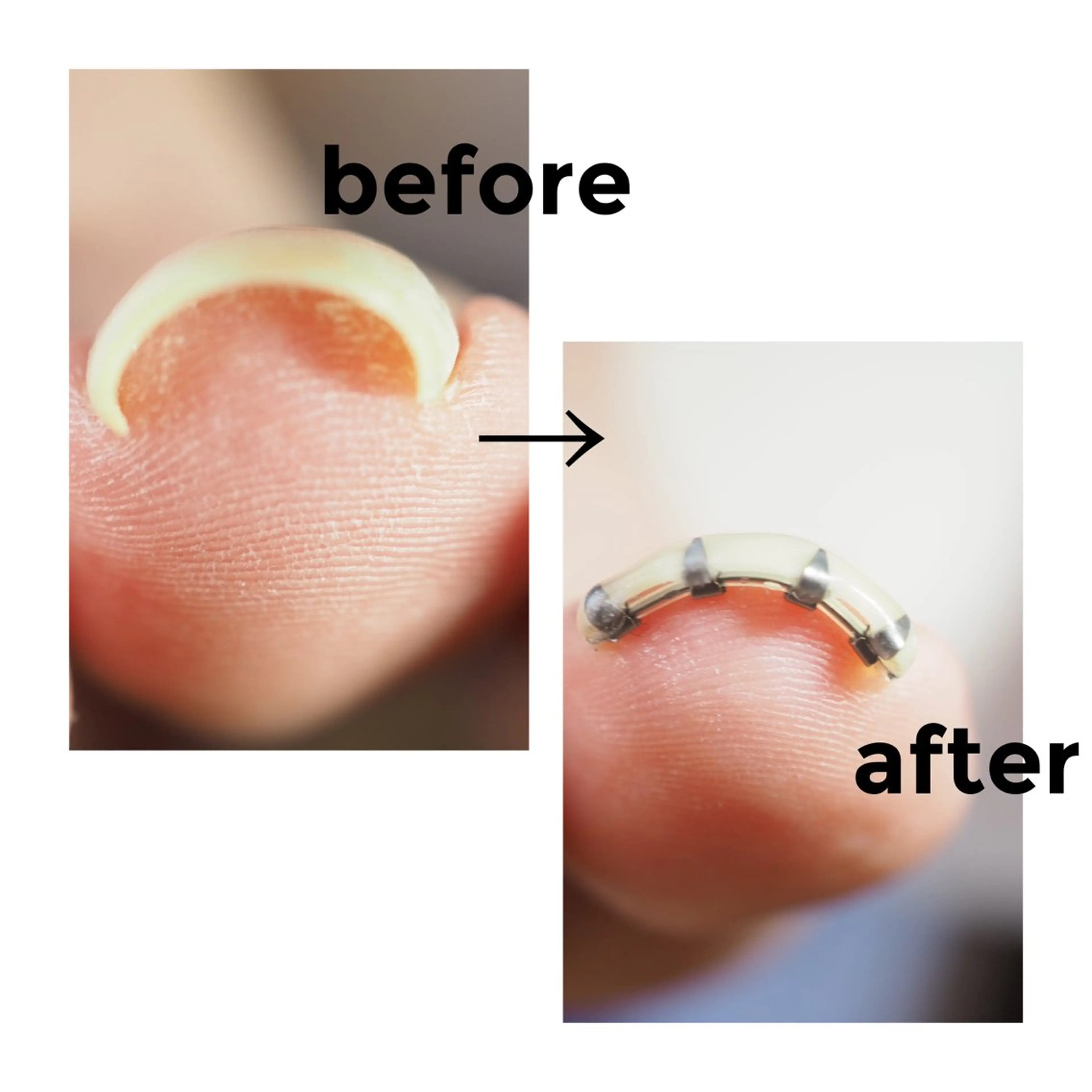 新規限定★巻き爪矯正　1本の写真