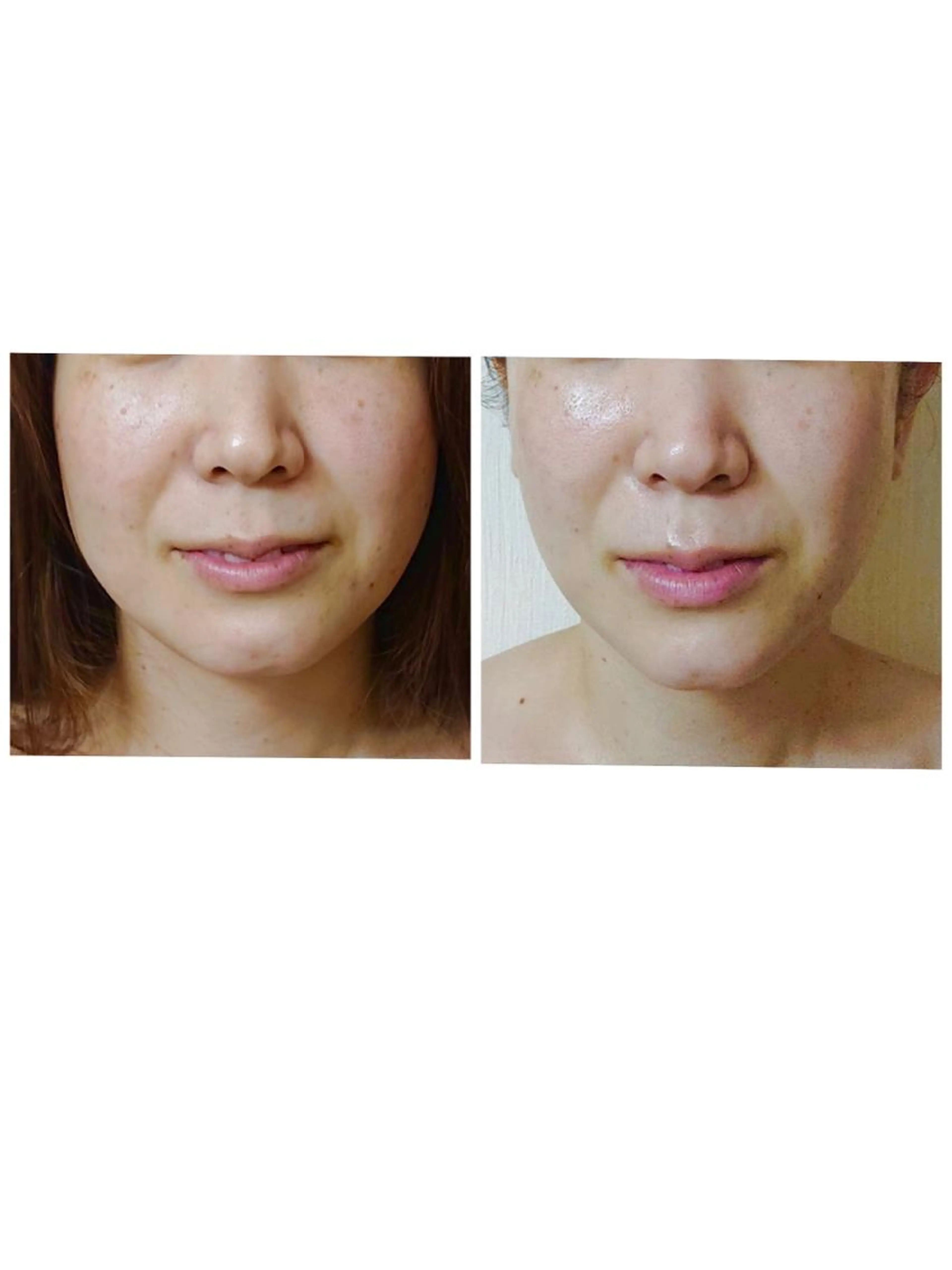 【超お得月2回の定額】小顔リフトアップコース（90分）✖️2回分の写真