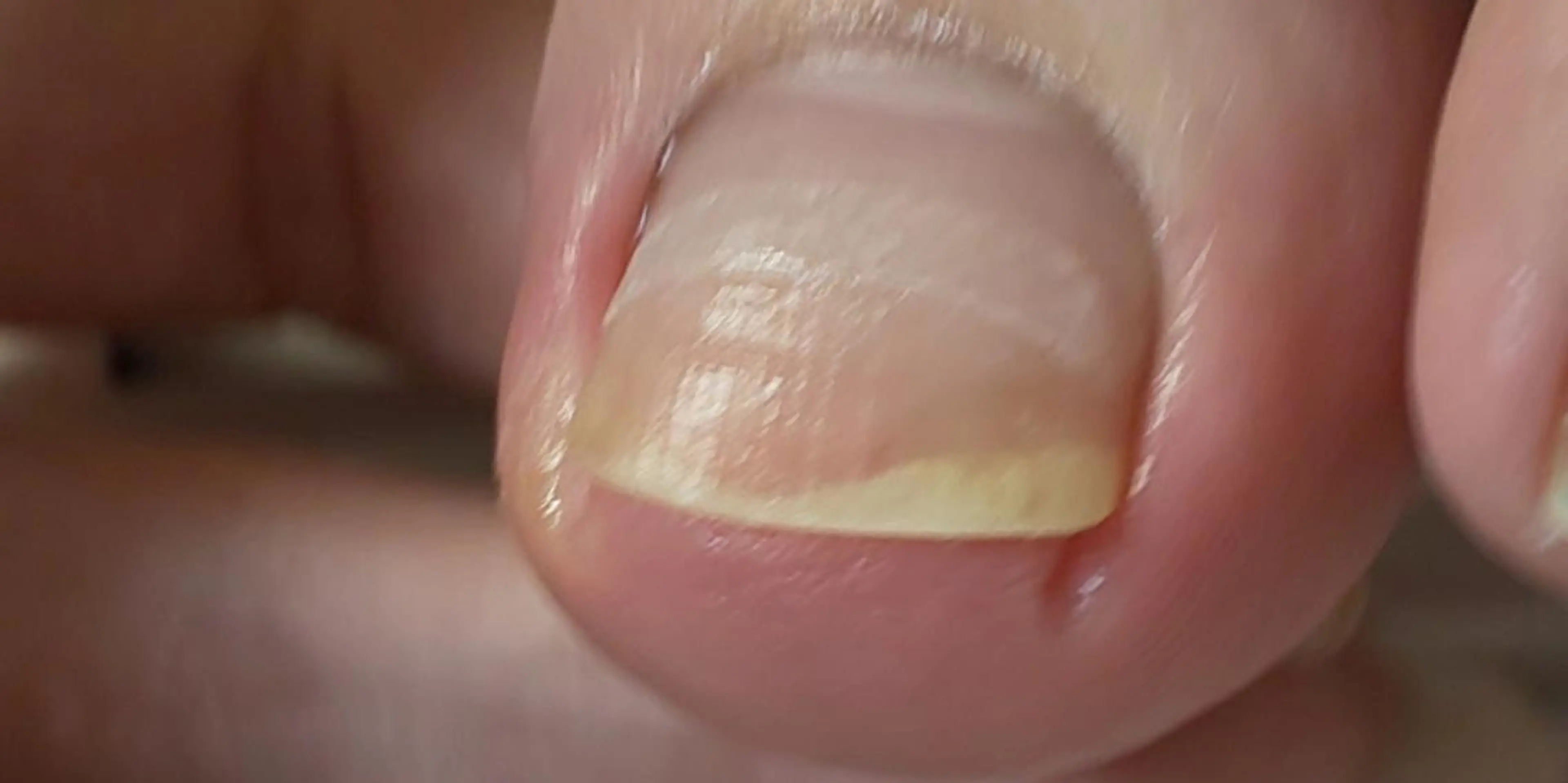 巻き爪ケアの写真