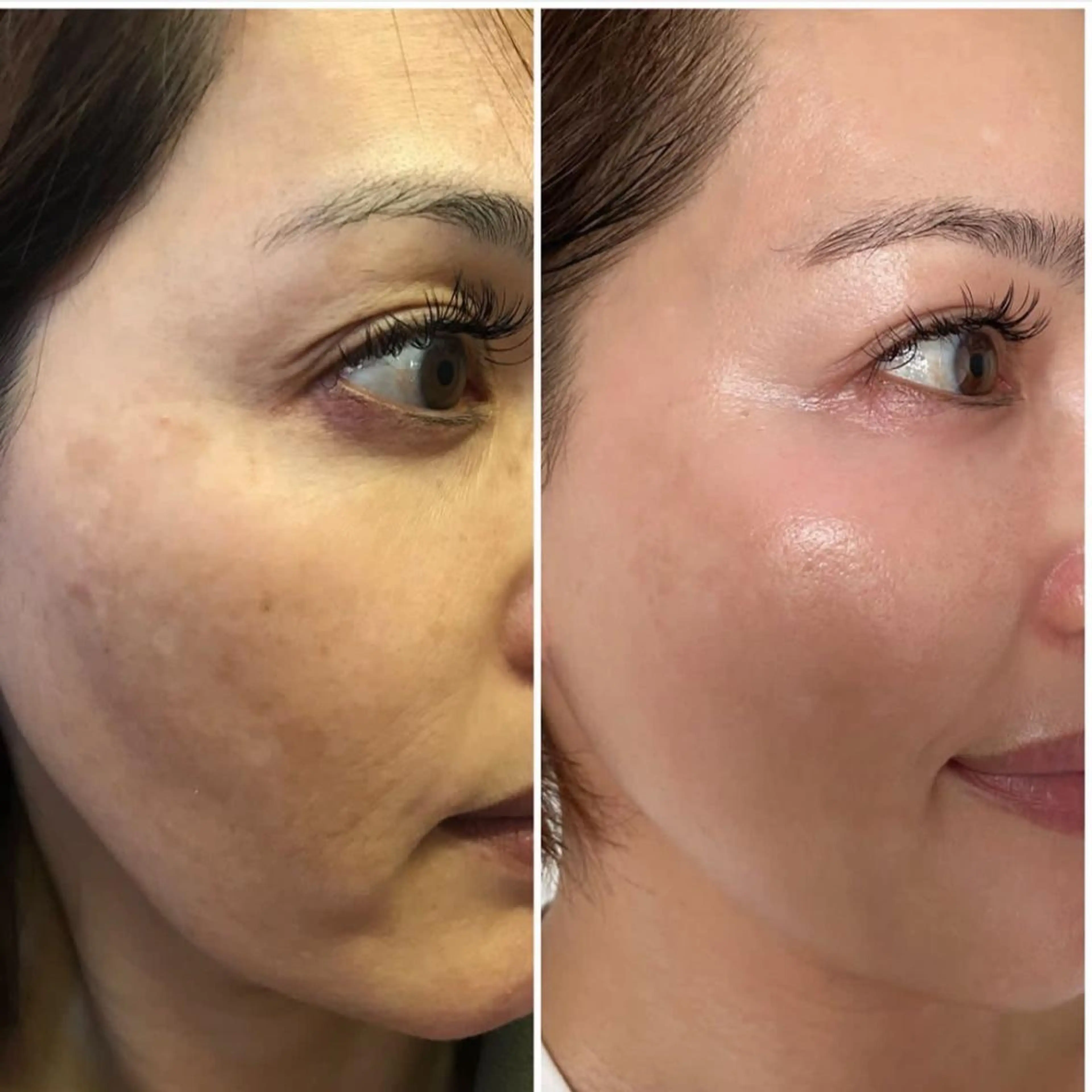 【フェイシャル】肌ファスティング体験の写真