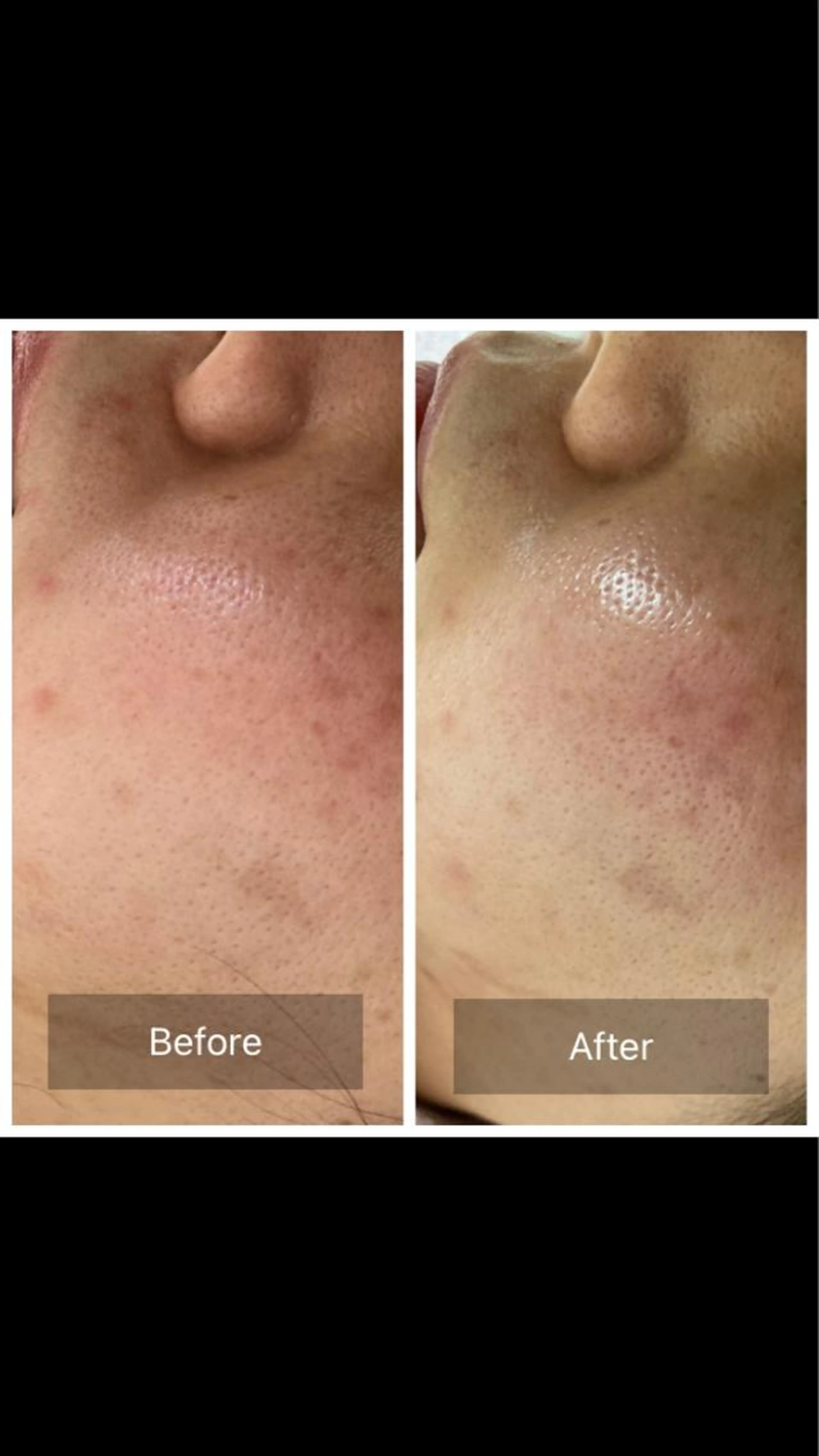 ハーブピーリング　剥けないタイプの写真