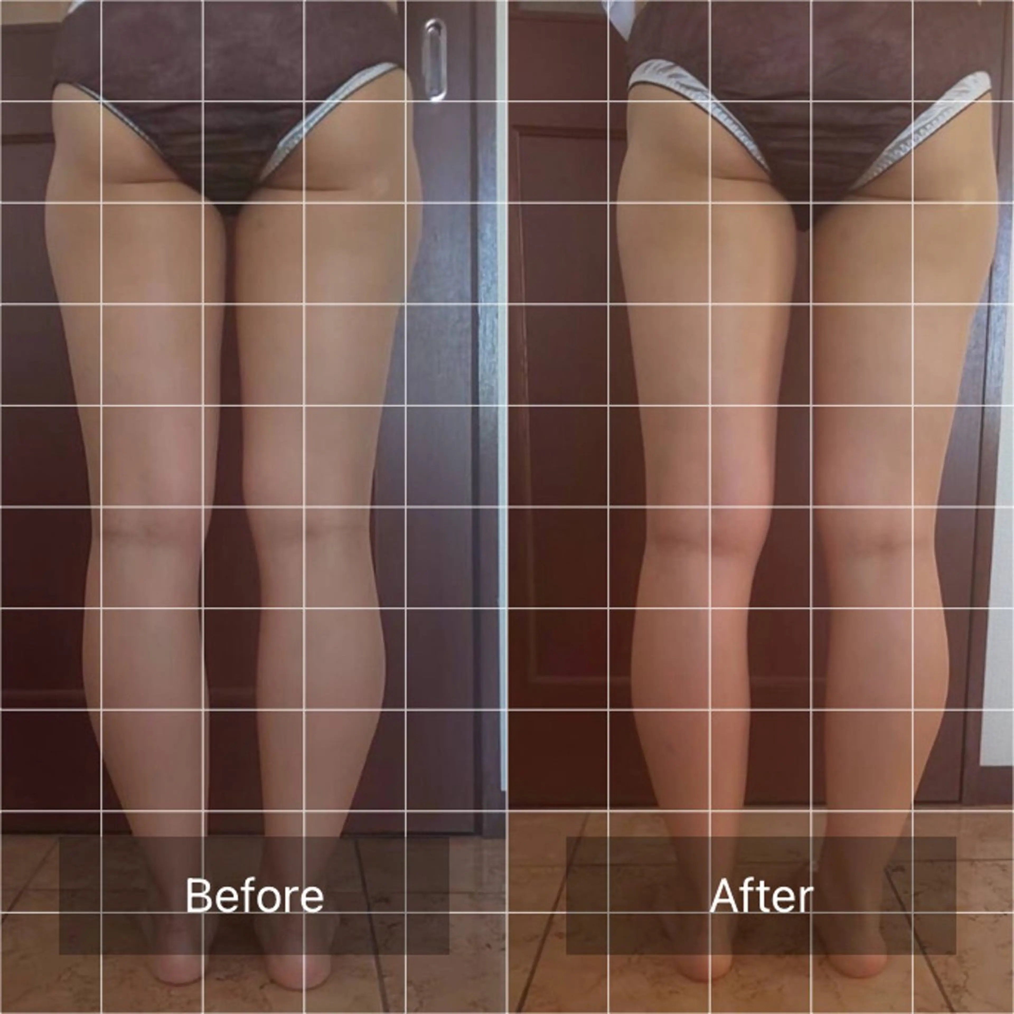 足痩せ施術の写真