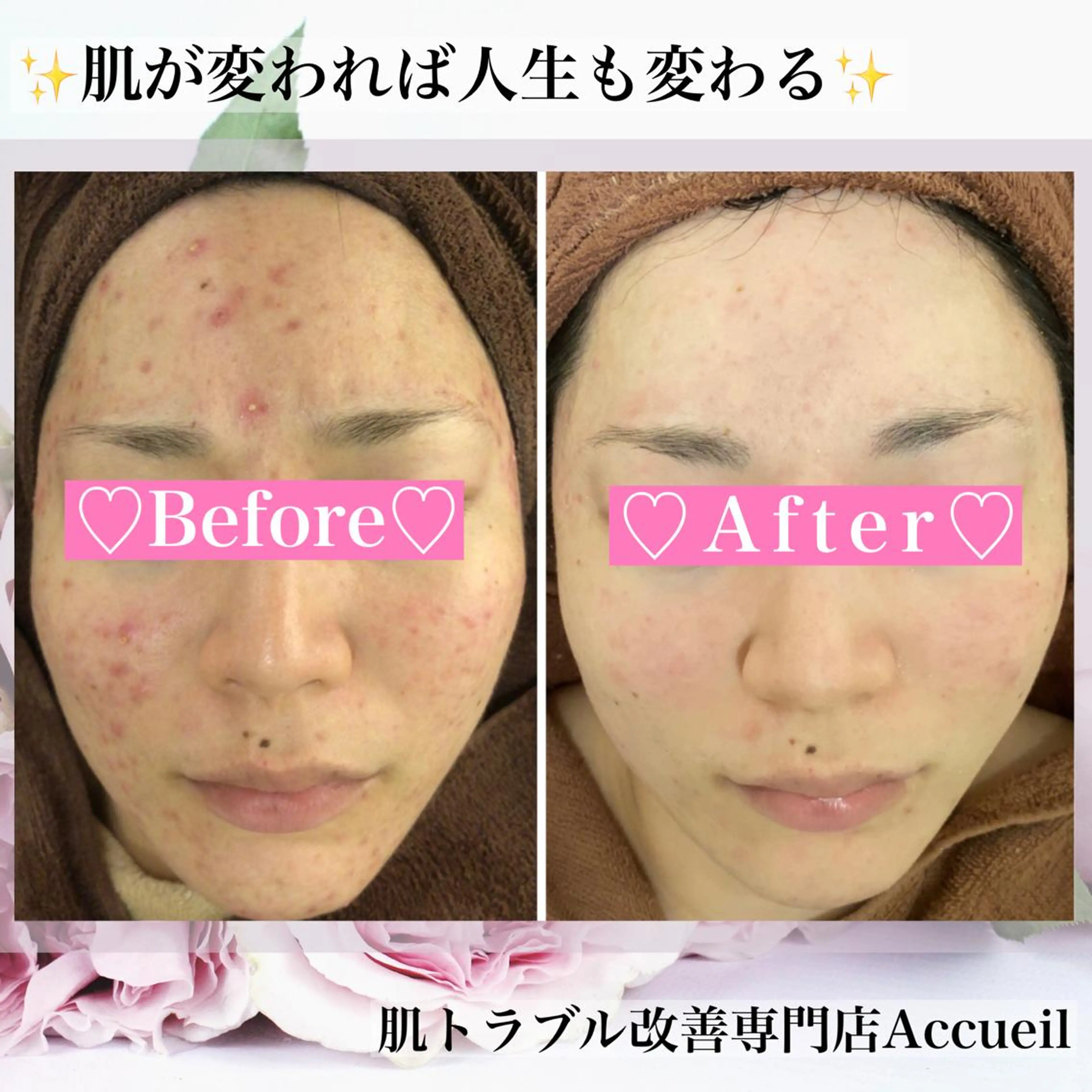 ミディアム カラー パーマ ヘアアレンジ メンズ キッズ ネイル マツエク・マツパ アイブロウ エステ リラク ニキビ・肌質改善専門 ♡人生が変わるサロンのエステ・リラクイメージ