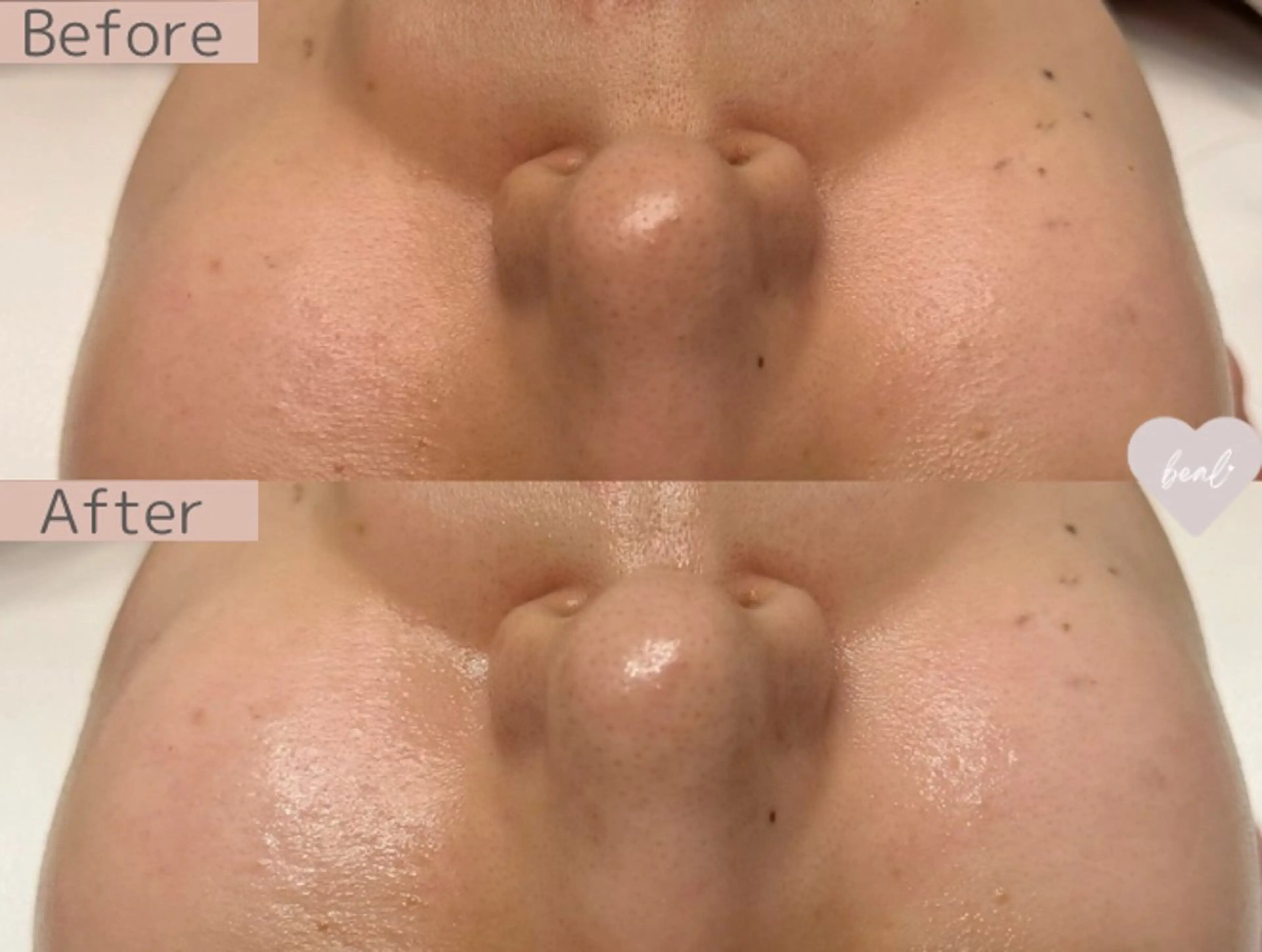 べアール所属・小顔/毛穴/ニキビ salon bealのエステ・リラクイメージ