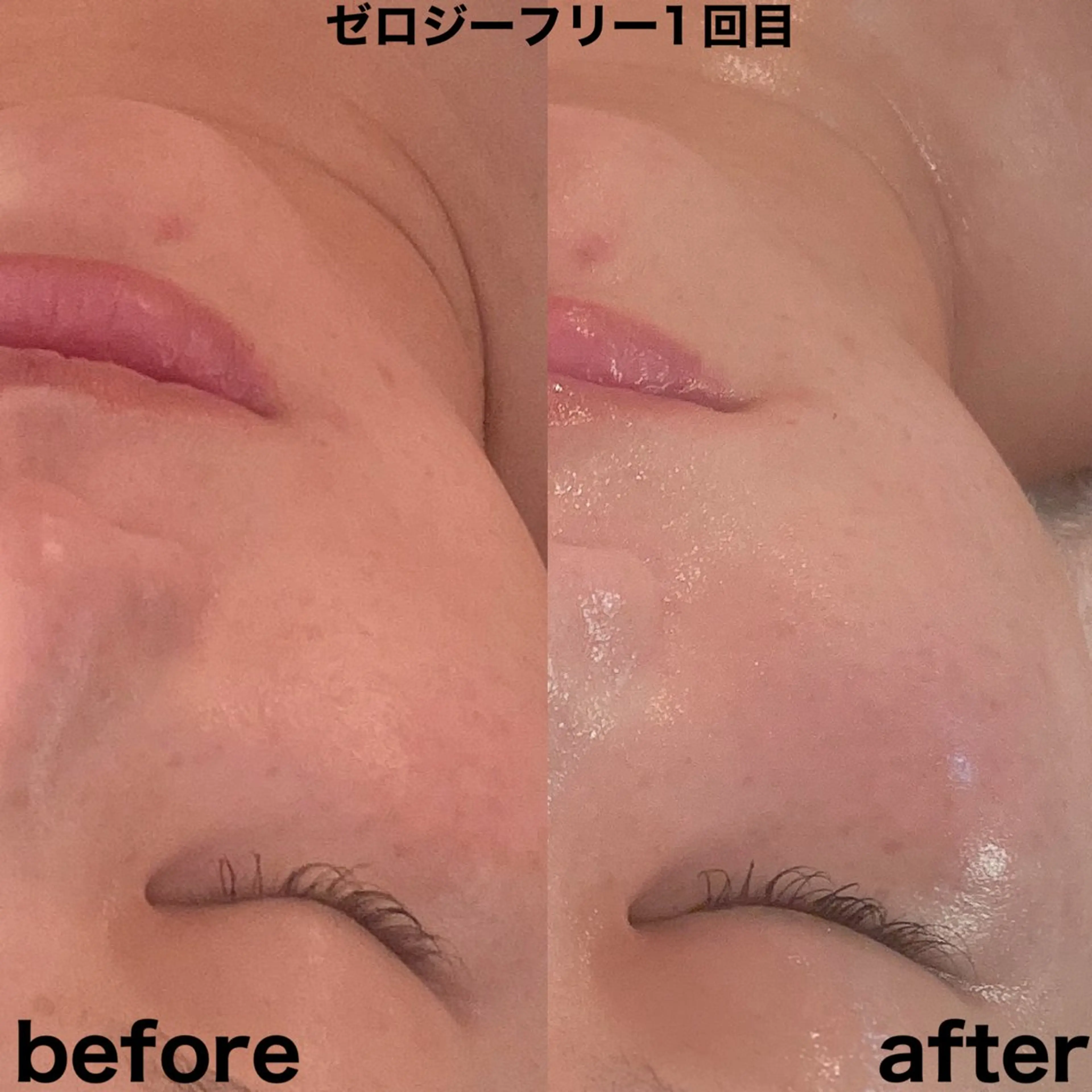 ゼロジーフリーリフトアップフェイシャルの写真