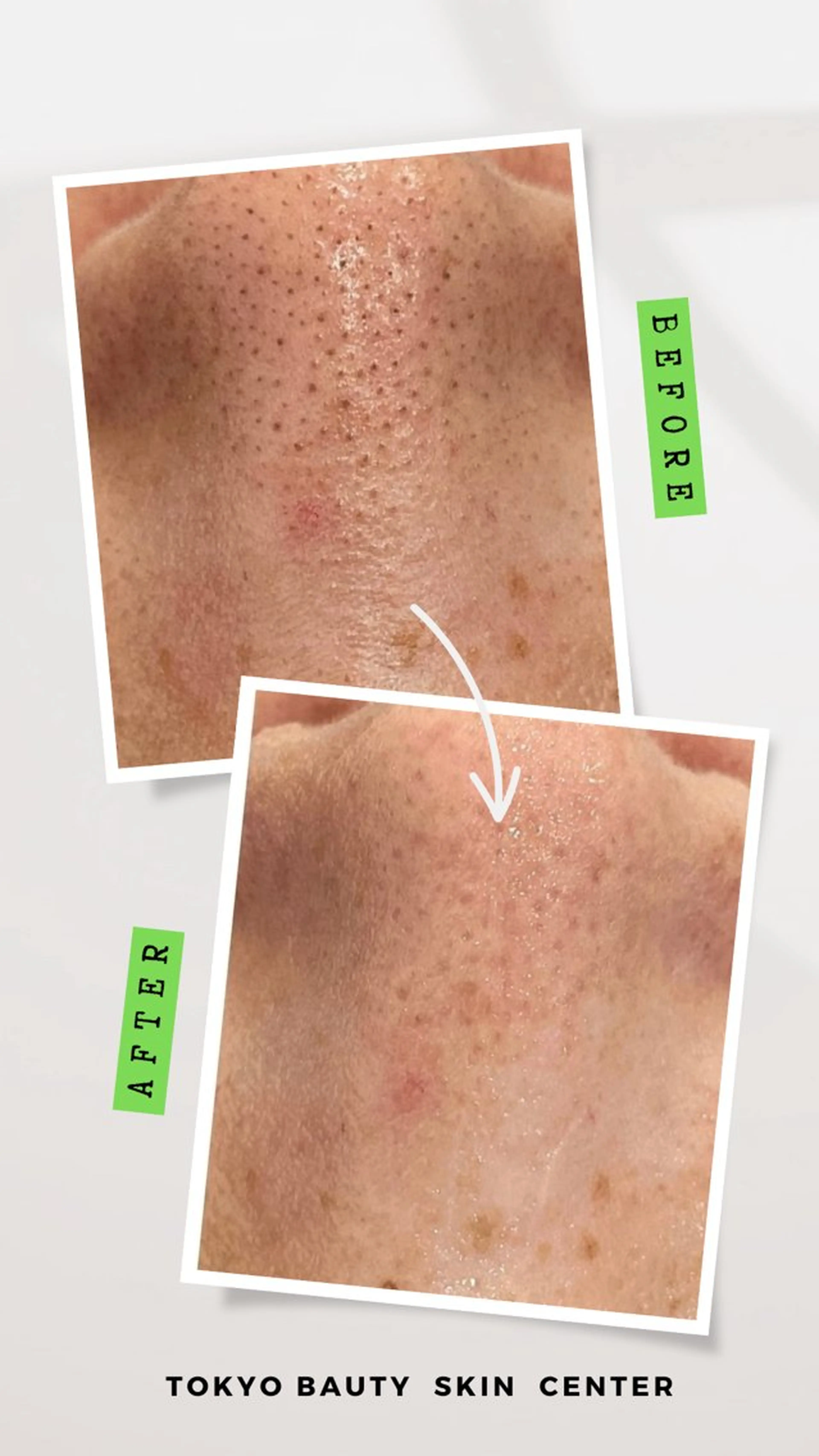 【人気No.1】毛穴汚れ一掃✨ハイドラ毛穴洗浄&顔脱毛& PDRN美白液導入!毛穴汚れムダ毛ちゅるん!キメの整った美肌!の写真