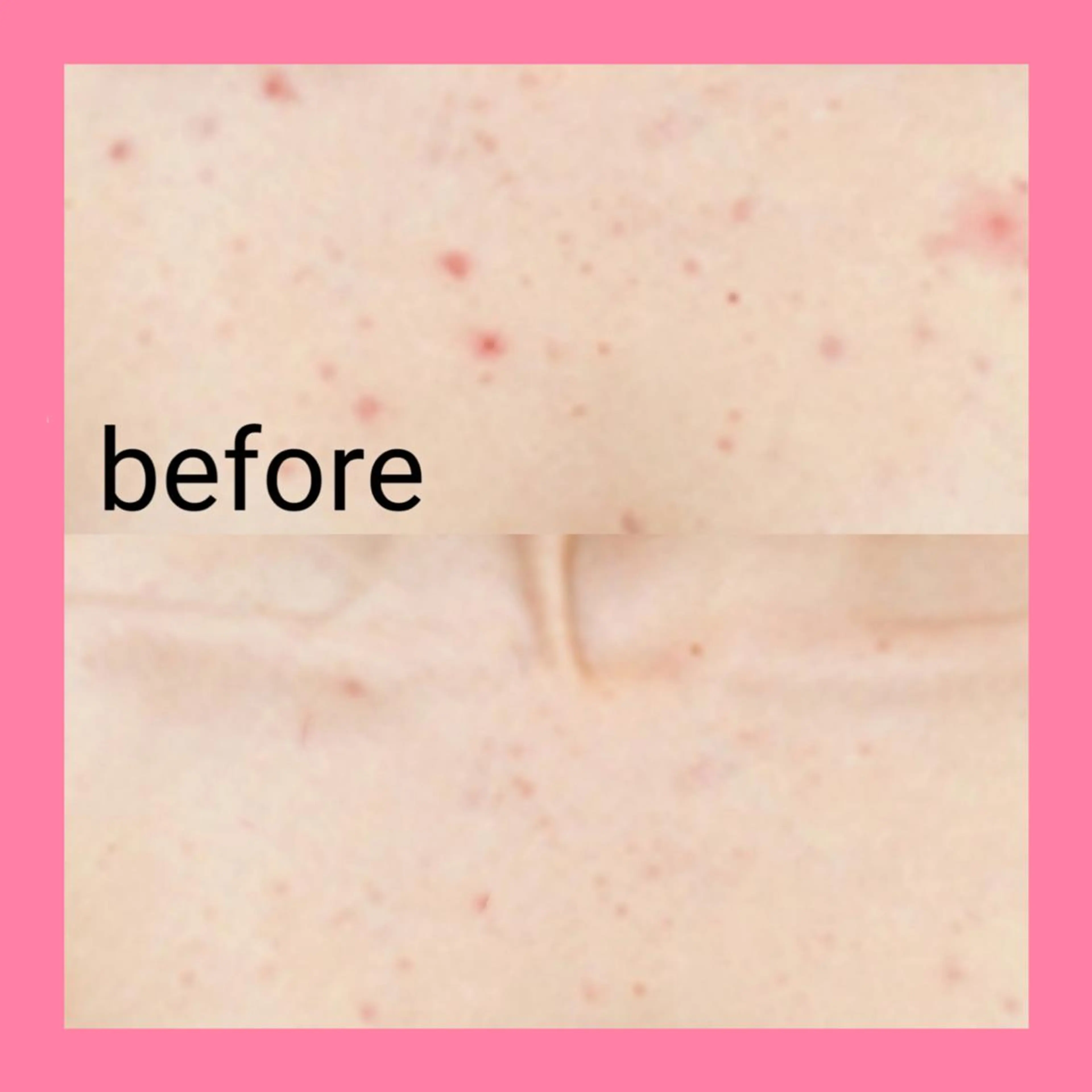 【デコルテ×谷間ケア】(3step)毛穴洗浄でデコルテ+谷間のニキビケア!パック付¥4500※ブライダルの方もオススメ♪の写真