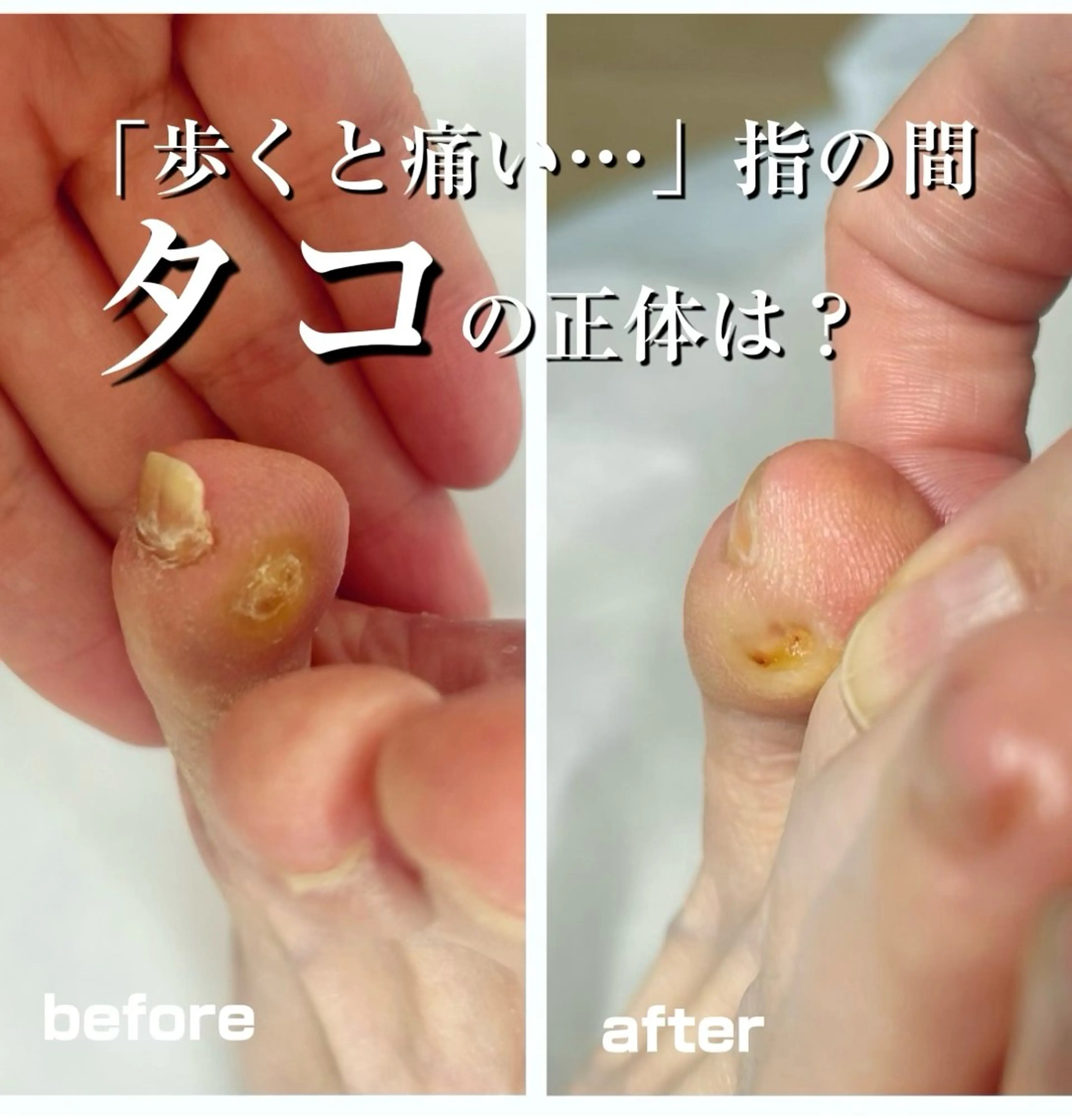 その他 巻き爪フットケアサロンKotori所属・フットケアサロン Kotoriのその他イメージ