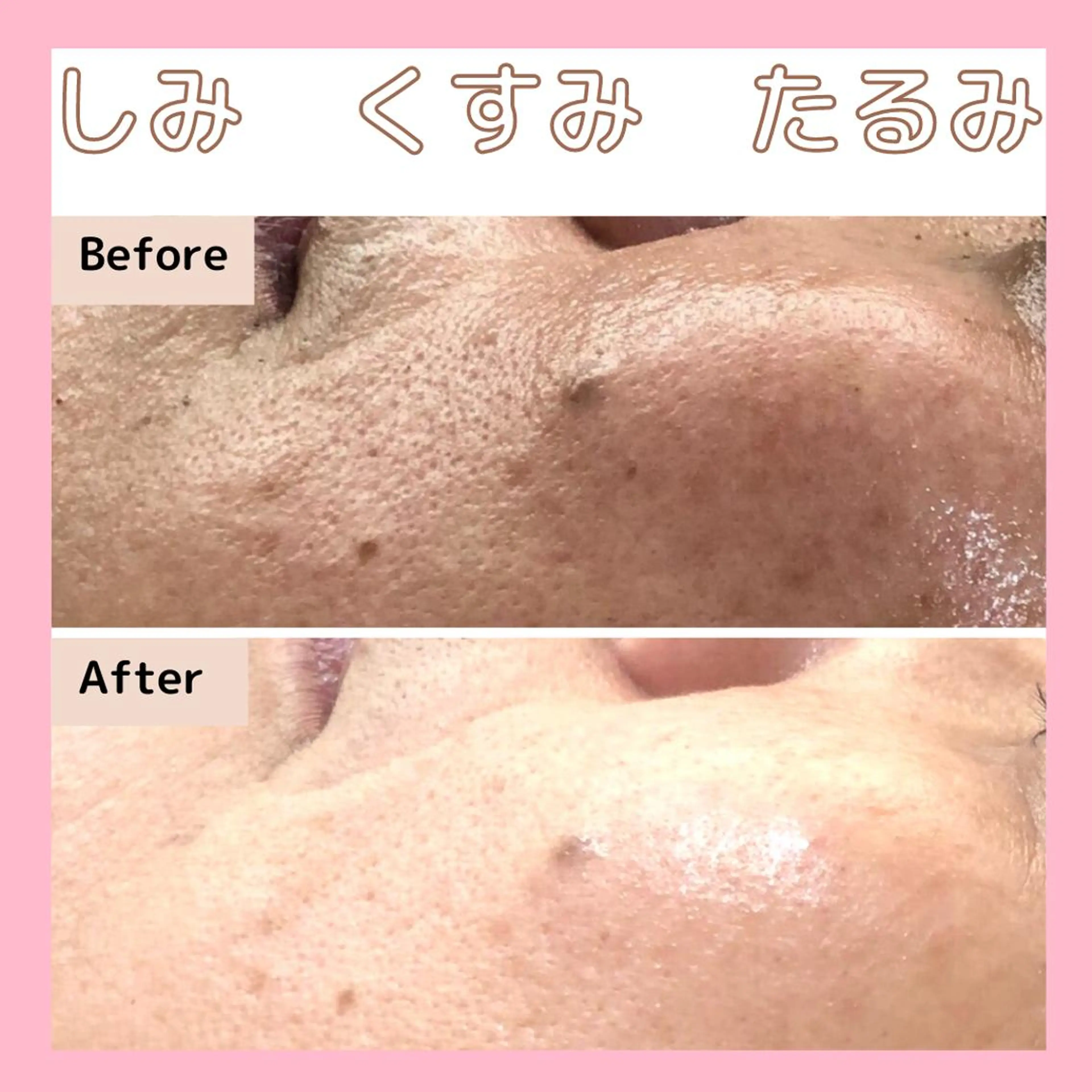 【しわ・たるみ肌】細胞修復機械と世界特許取得高濃度生コラーゲンで肌の土台からプルップル透明感肌へ◎の写真