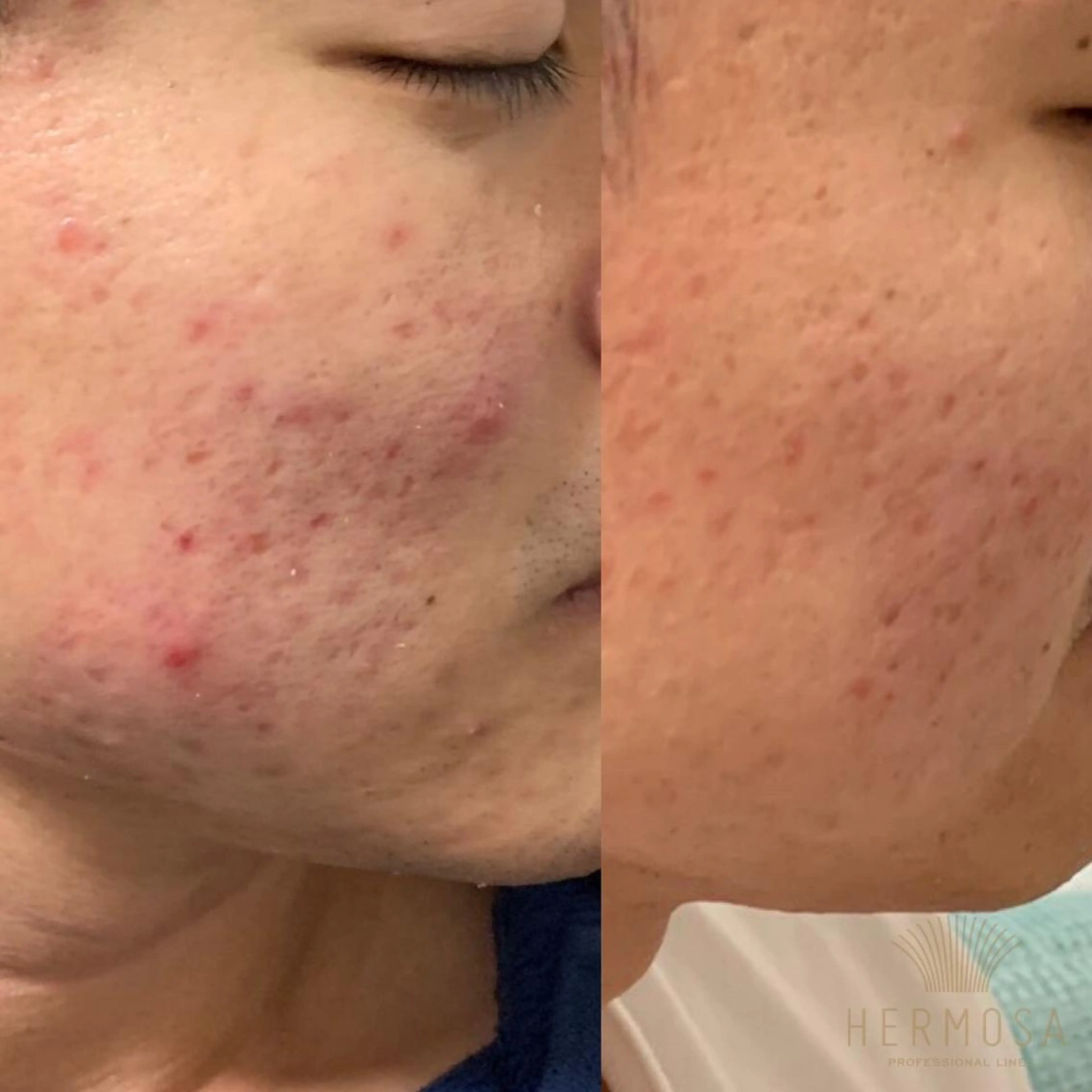 【ニキビ/肌管理】 salon varyのエステ・リラクイメージ