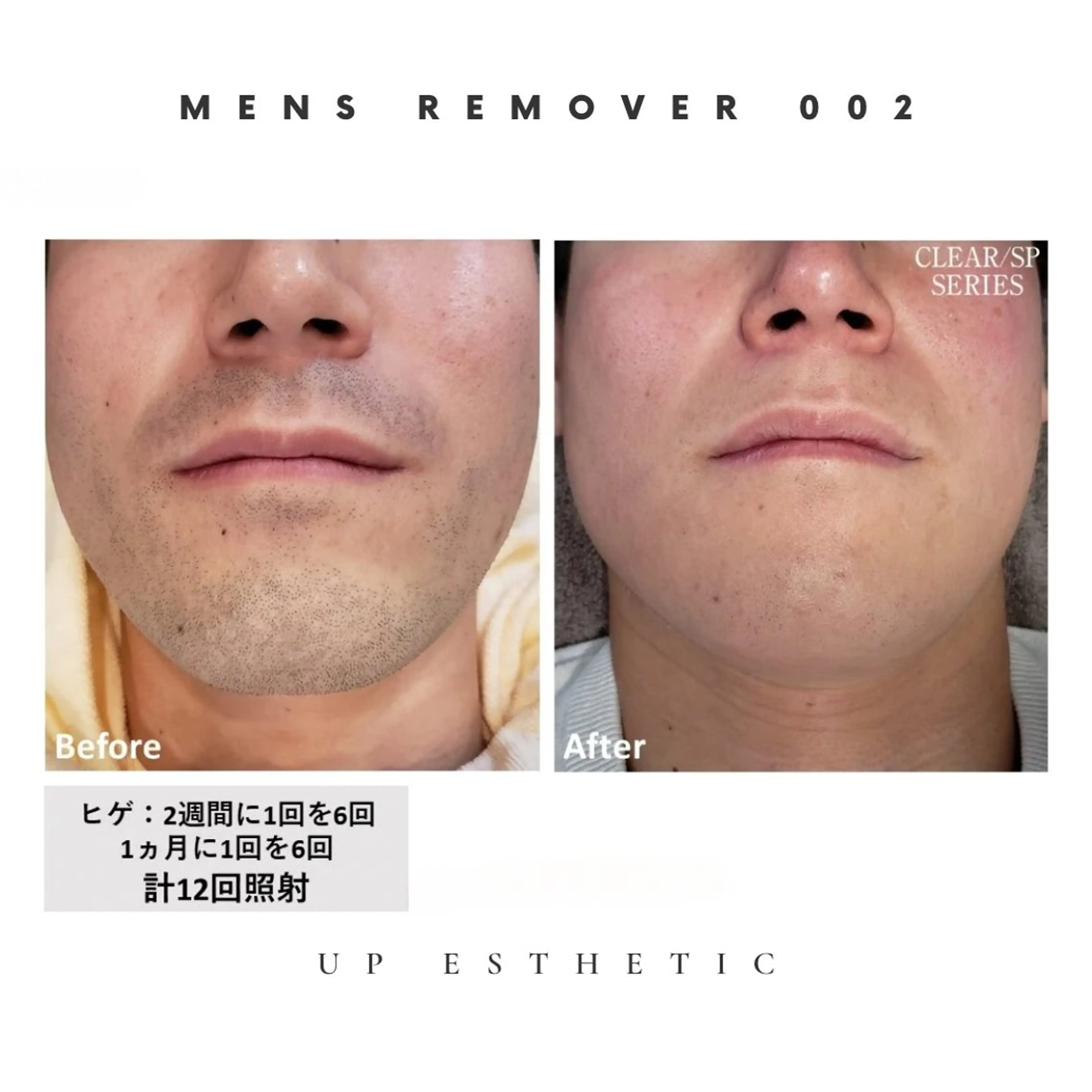 メンズ 脱毛 韓国肌管理 ウプエステティックのエステ・リラクイメージ