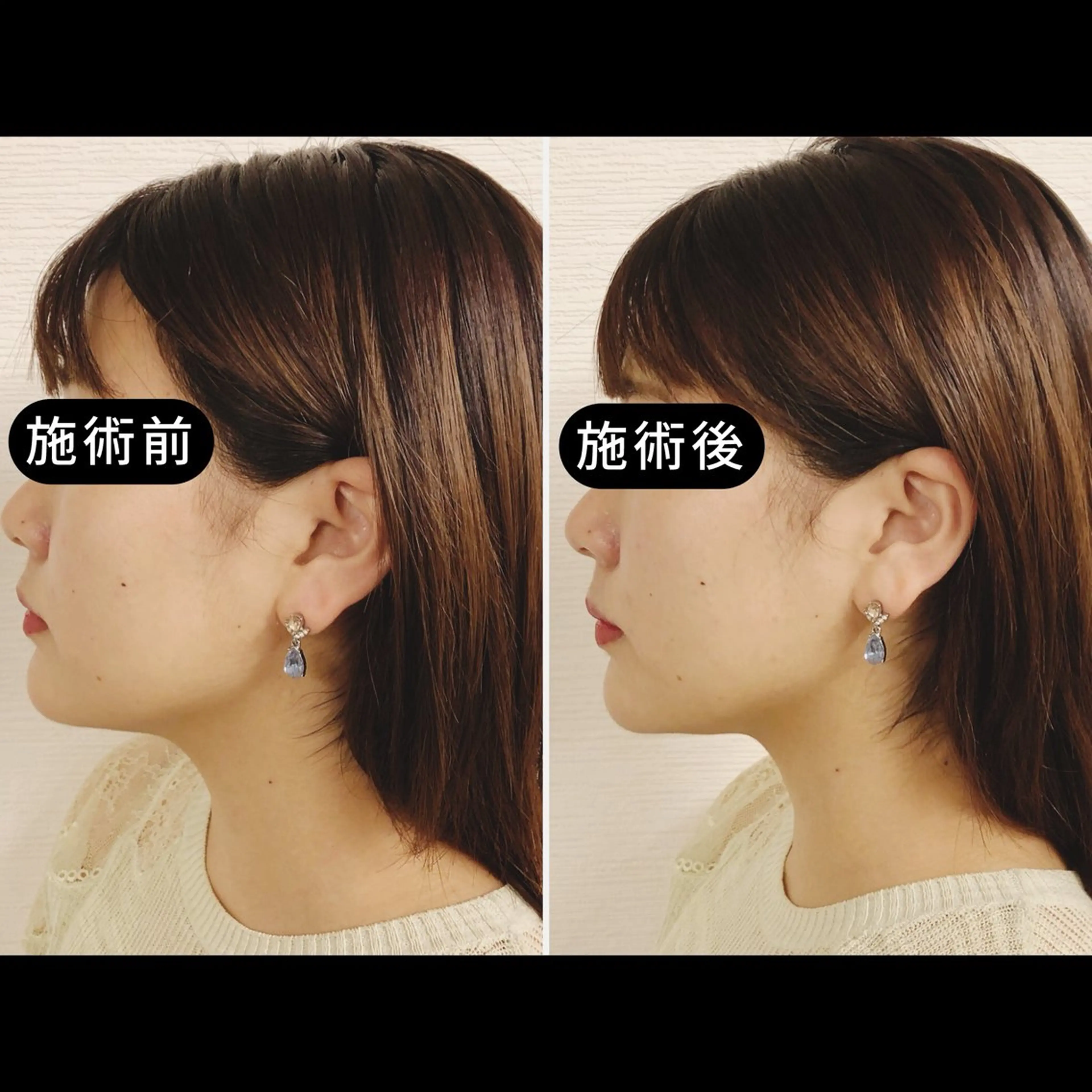 エステ リラク 渋谷 小顔美容鍼 専門サロン YZのエステ・リラクイメージ