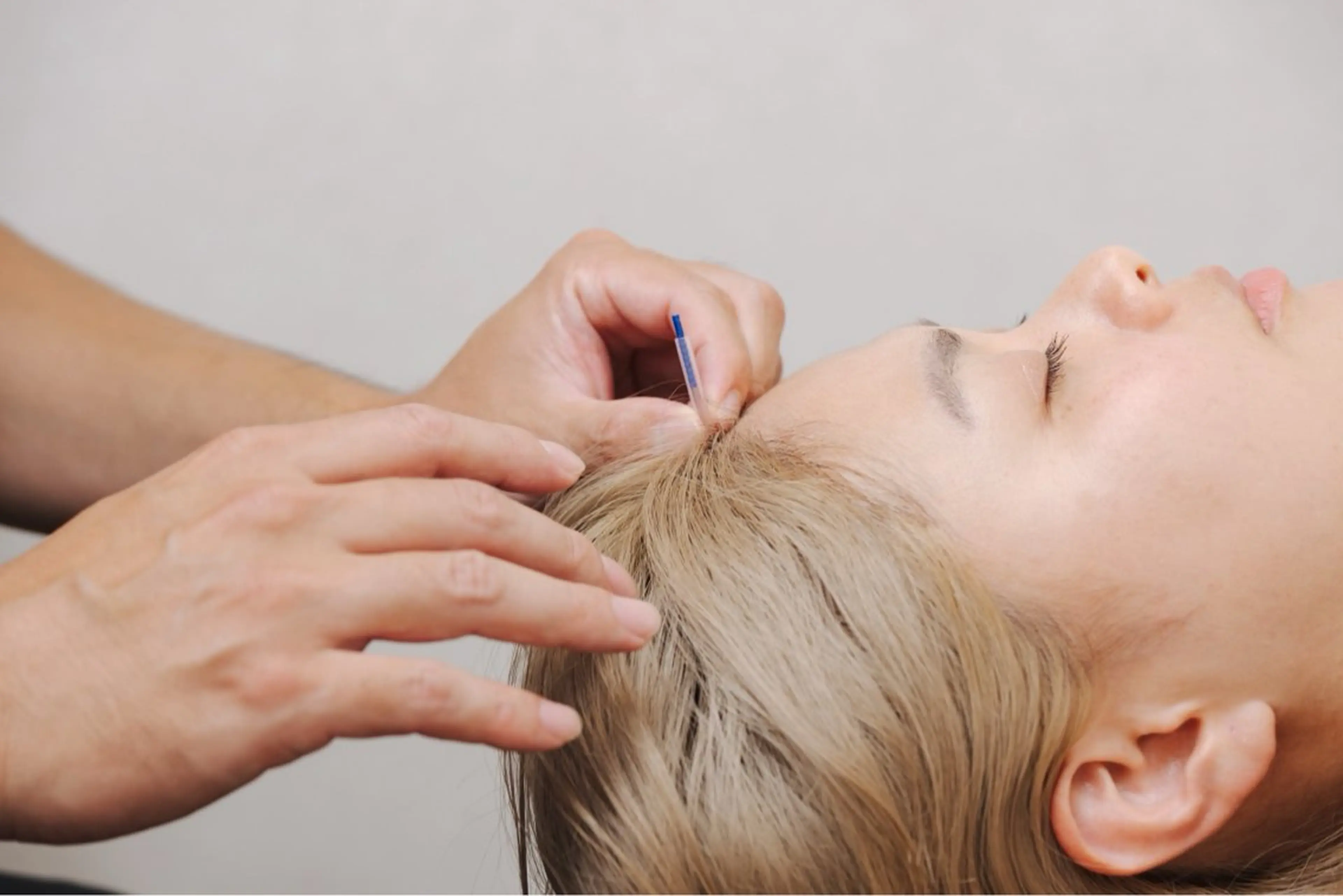 【まずは体験】初めての美容鍼に◎お悩み集中クイックコース30分✨15項目分析×自律神経美容鍼で変化を実感💆‍♀️の写真