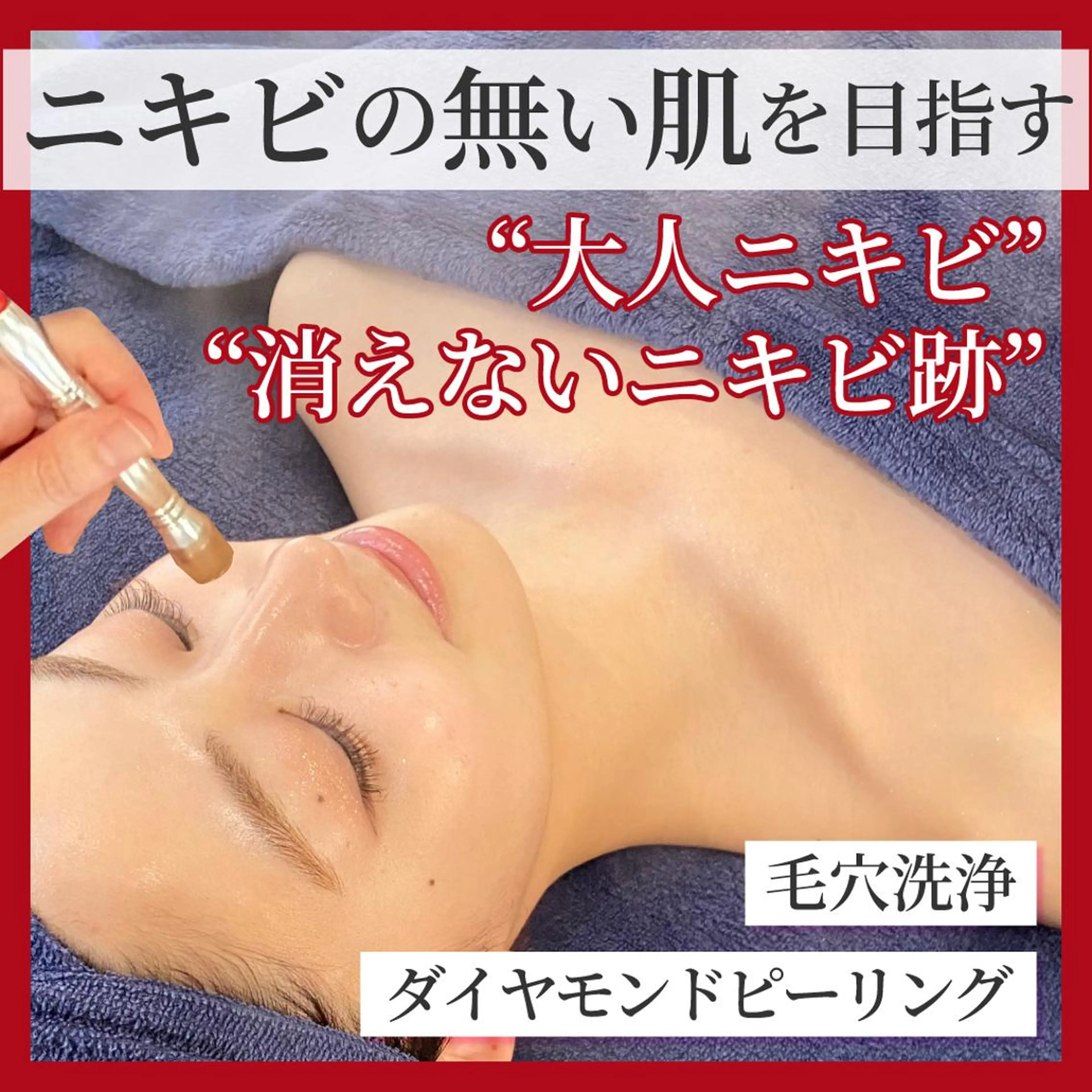 【本気のニキビケア】AI肌診断+ダイヤモンドピーリング+美容液導入+モチモチ美白パック★今だけ顔脱毛プレゼント中の写真